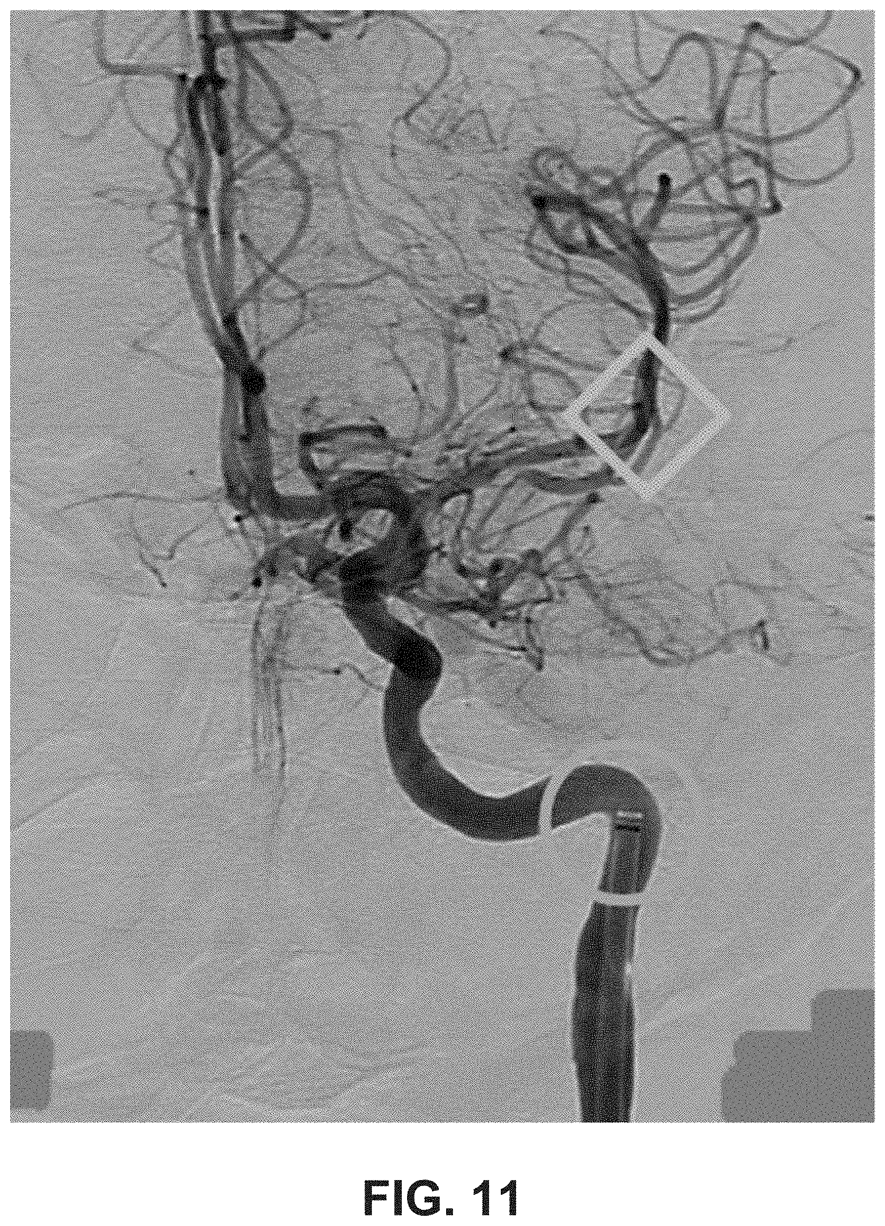 Patent US11779406 Figure 14 – Systems and methods for guidance of intraluminal devices within the vasculature