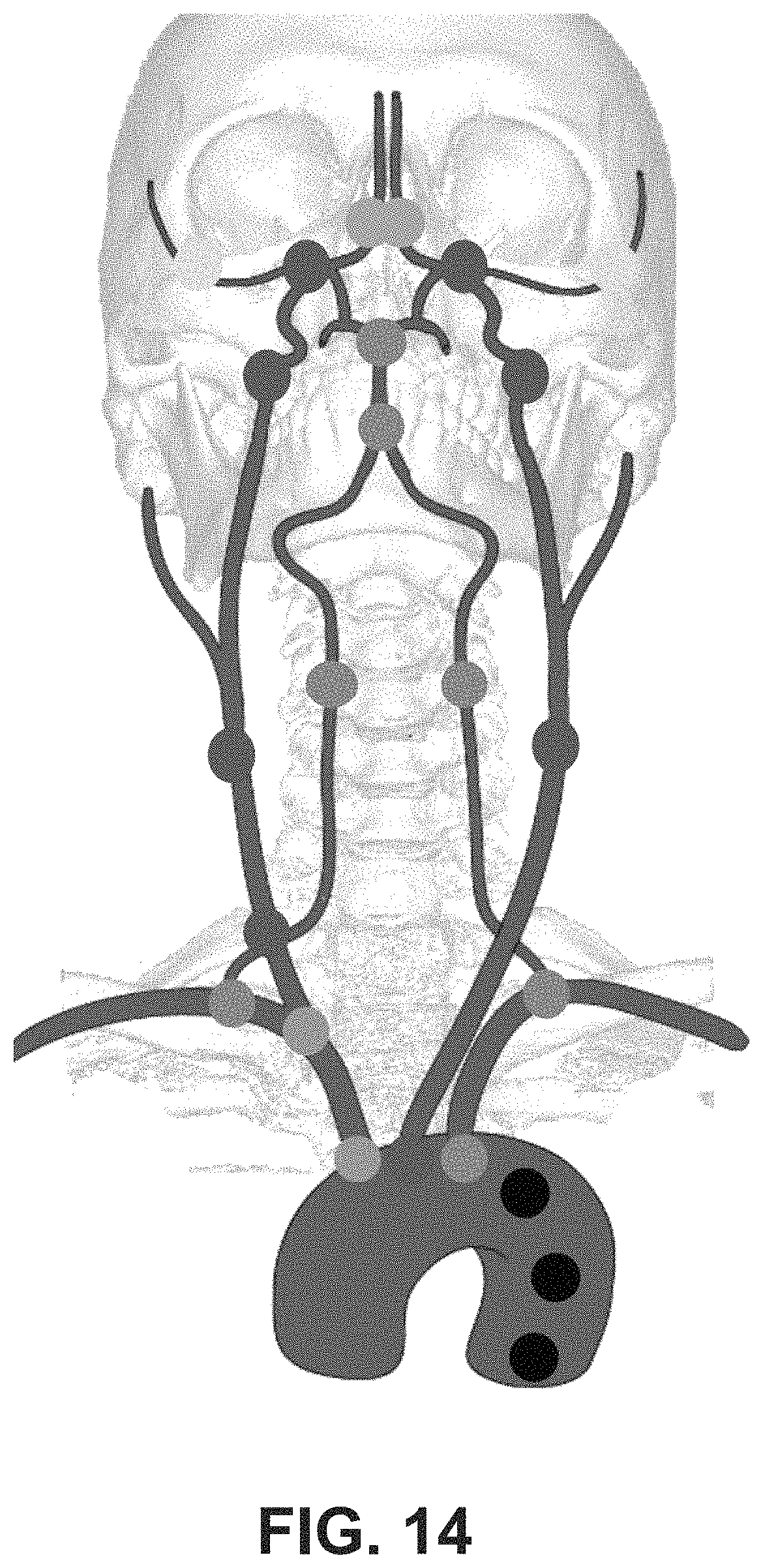 Patent US11779406 Figure 17 – Systems and methods for guidance of intraluminal devices within the vasculature