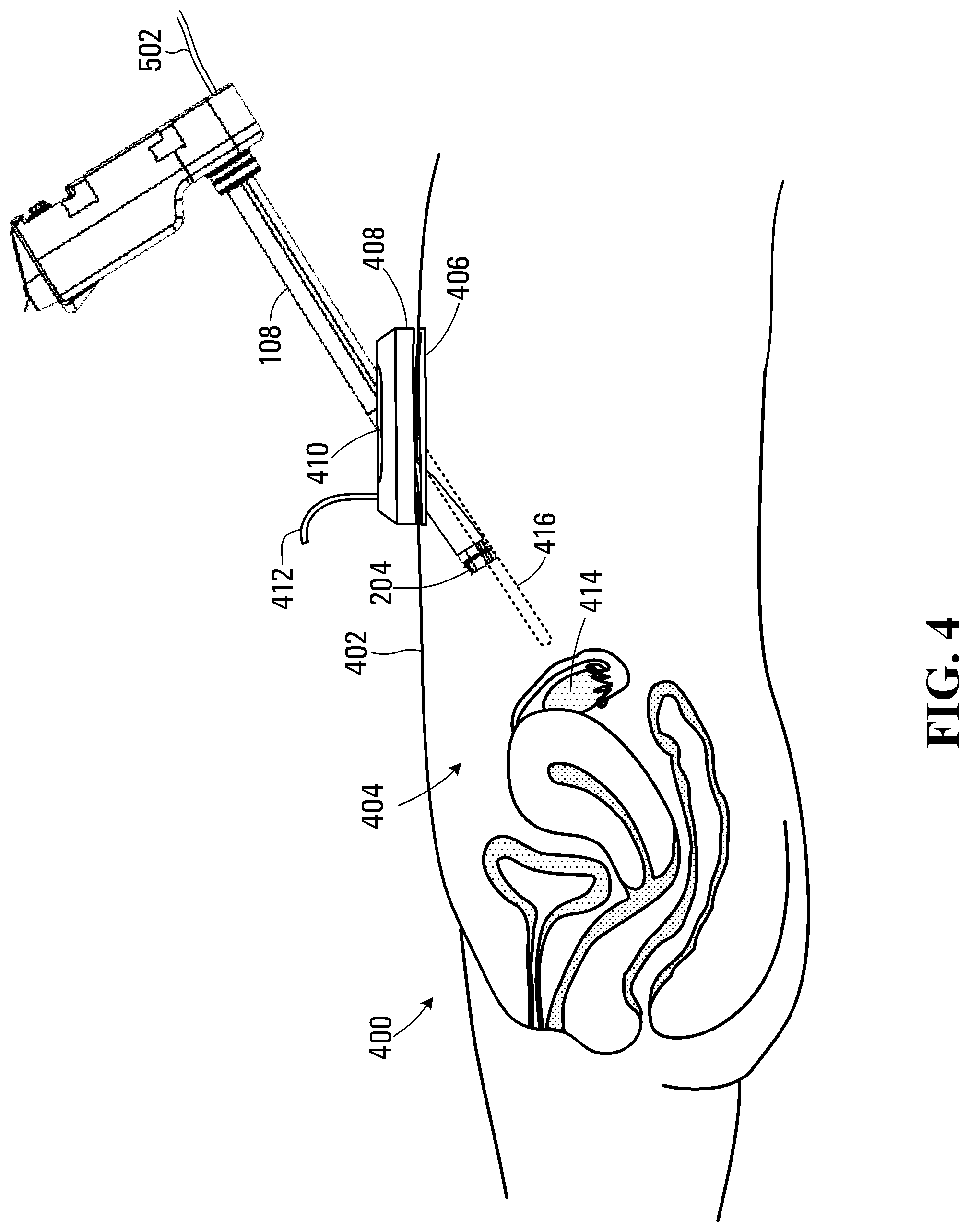 Patent US11779418 Figure 3 – System and apparatus for positioning an instrument in a body cavity for performing a surgical procedure