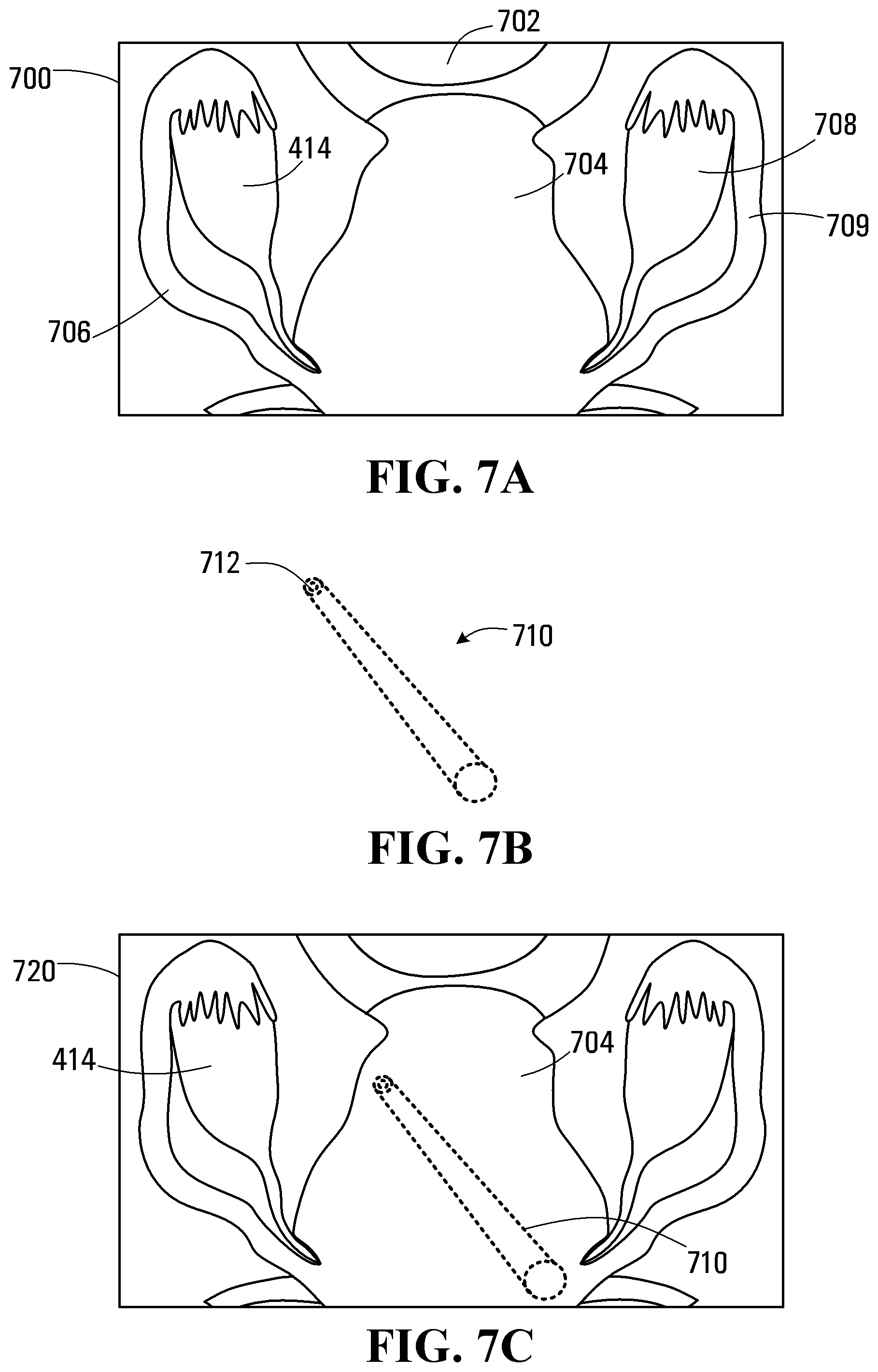 Patent US11779418 Figure 5 – System and apparatus for positioning an instrument in a body cavity for performing a surgical procedure