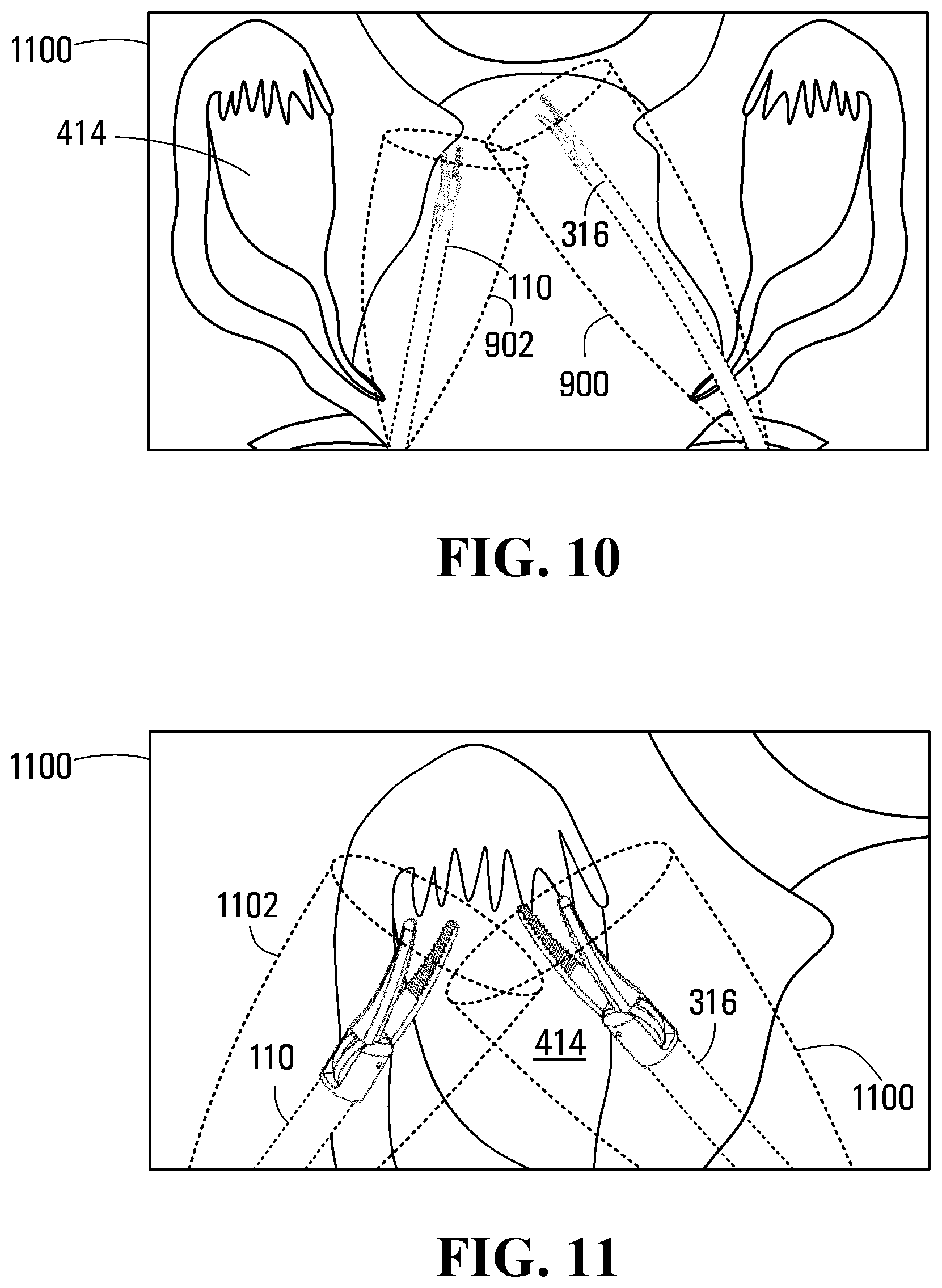 Patent US11779418 Figure 7 – System and apparatus for positioning an instrument in a body cavity for performing a surgical procedure