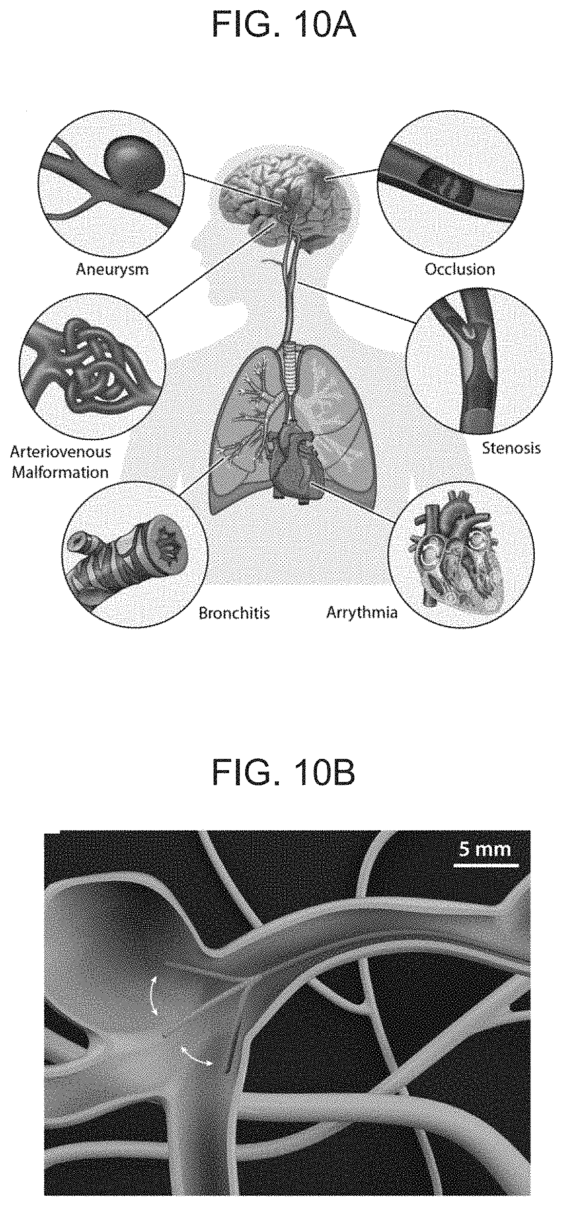 Patent US11779422 Figure 13 – Magnetically steerable continuum robotic guidewires for neurovascular applications