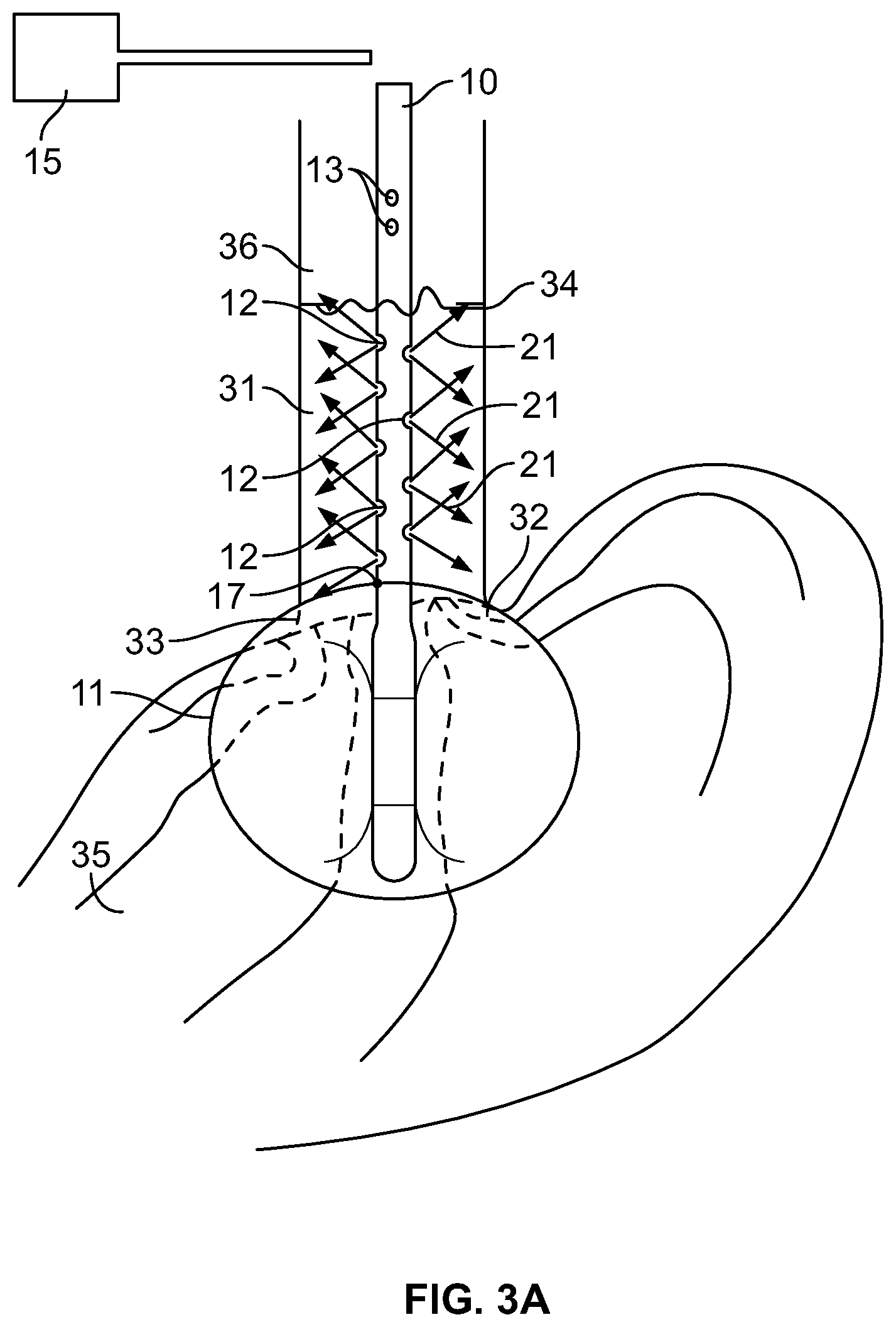 Patent US11779430 Figure 8 – Vapor based ablation system for treating uterine bleeding