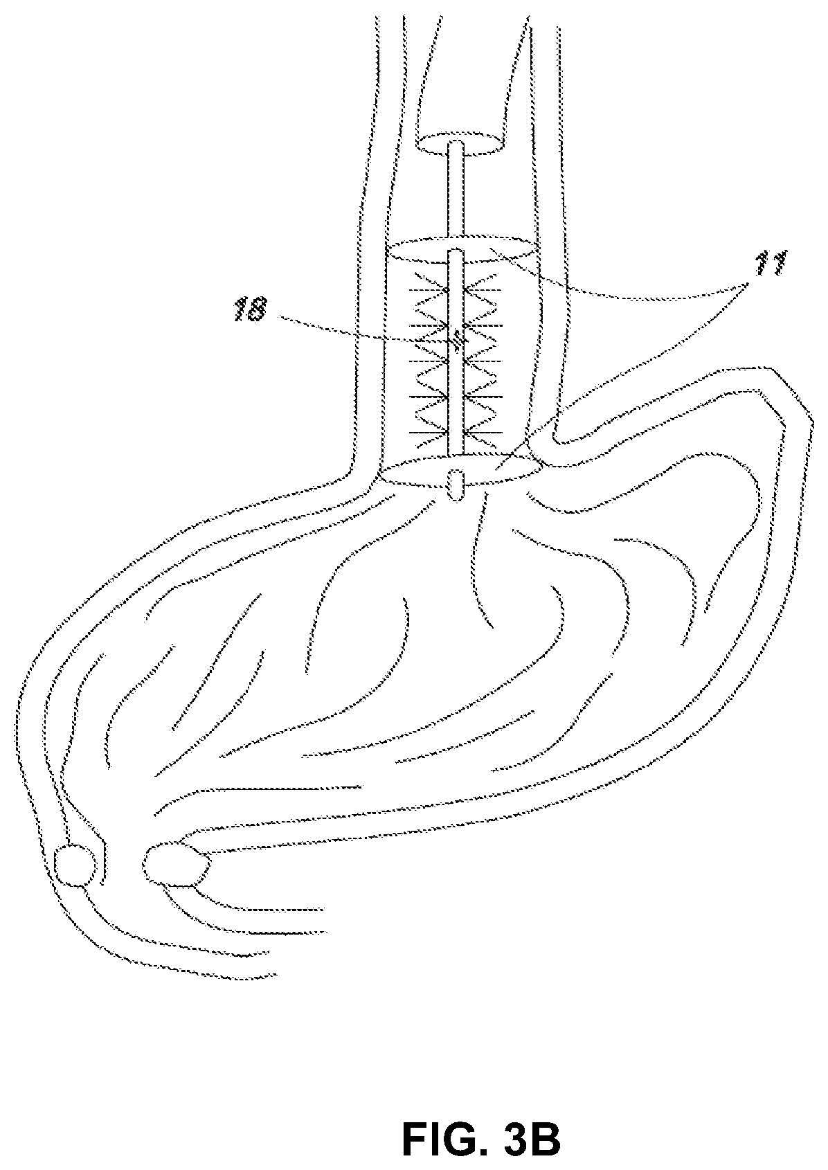 Patent US11779430 Figure 9 – Vapor based ablation system for treating uterine bleeding