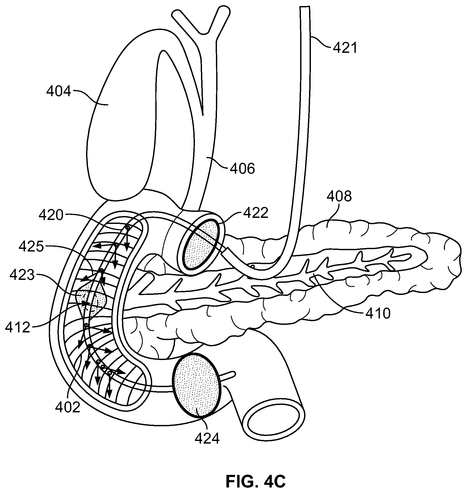 Patent US11779430 Figure 17 – Vapor based ablation system for treating uterine bleeding