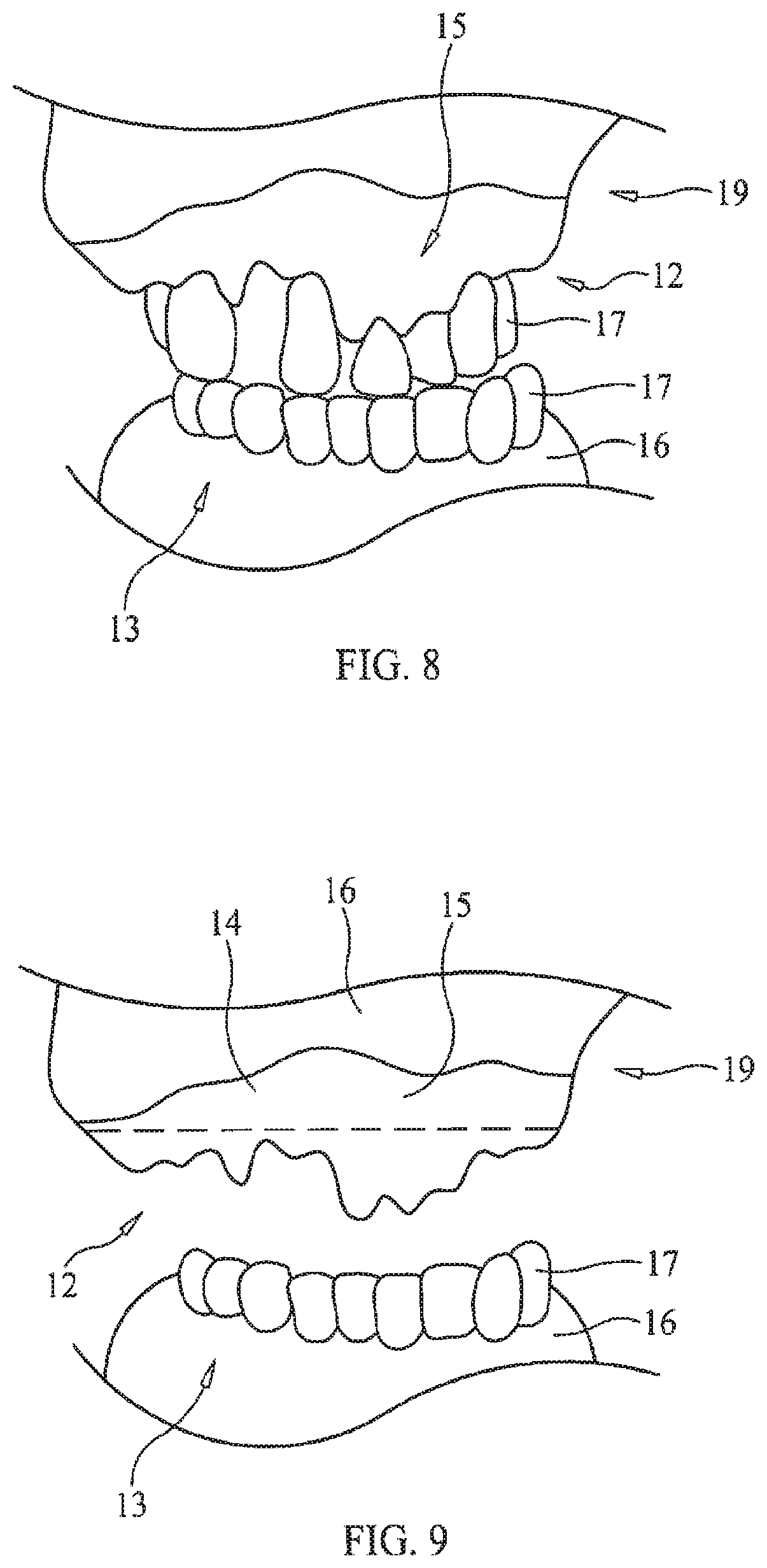 Patent US11779434 Figure 5 – Bone foundation guide system and method