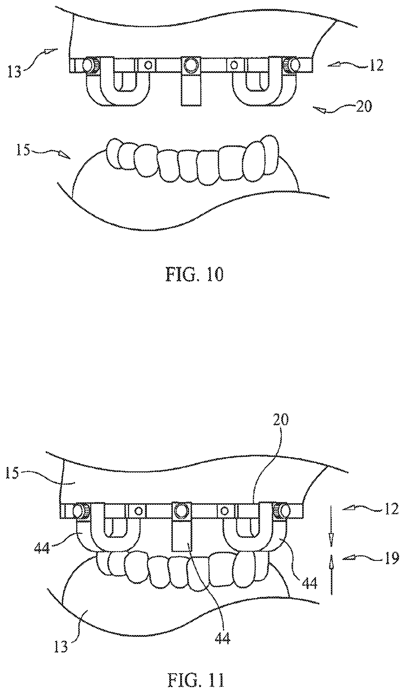 Patent US11779434 Figure 6 – Bone foundation guide system and method