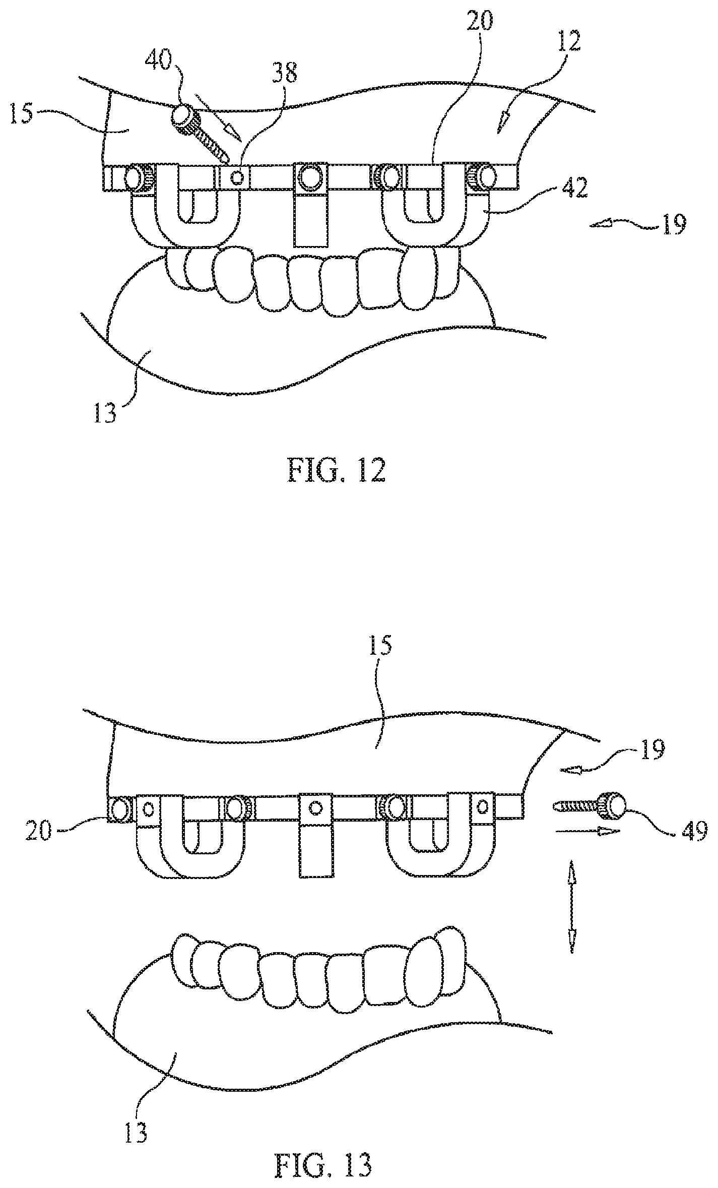 Patent US11779434 Figure 7 – Bone foundation guide system and method