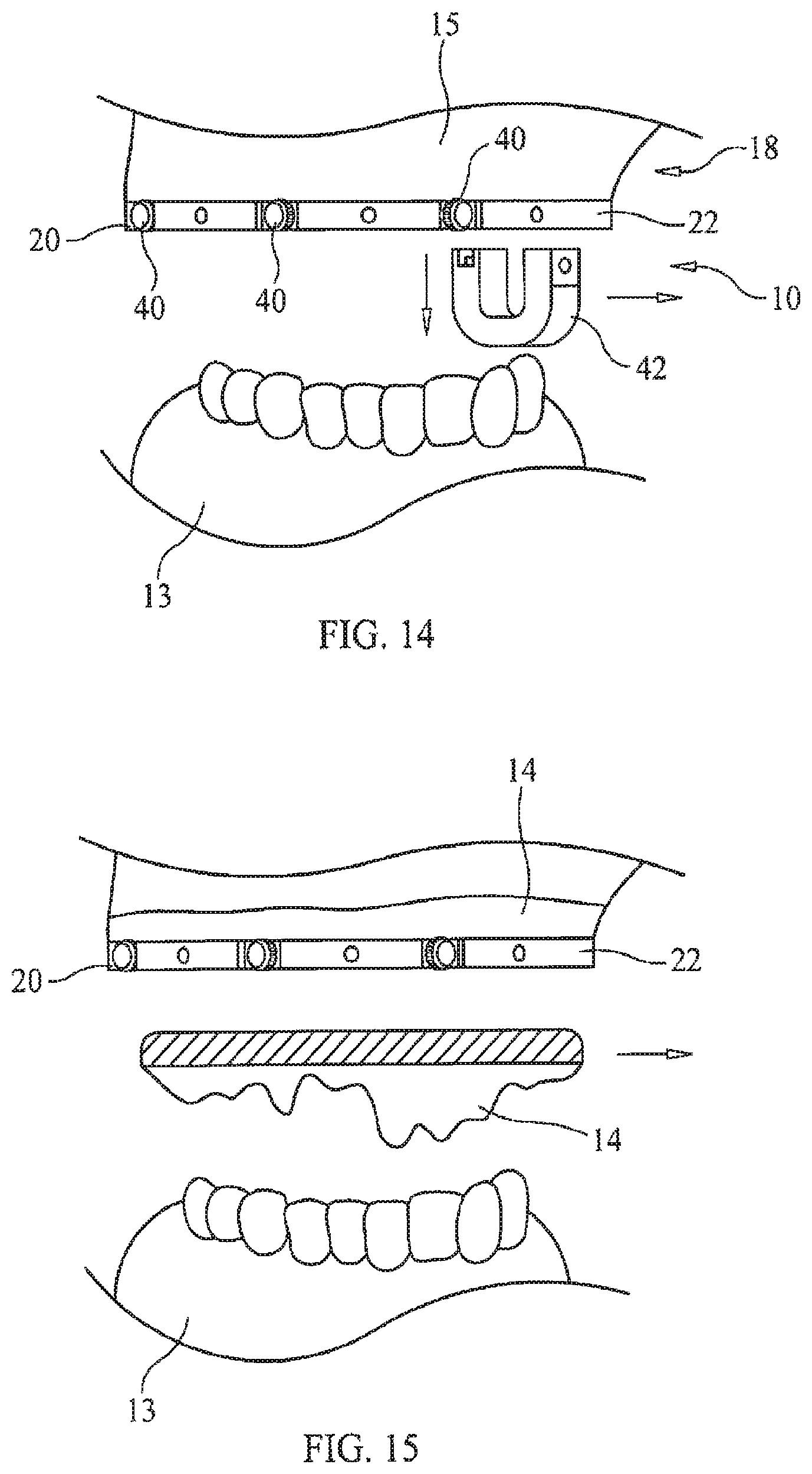 Patent US11779434 Figure 8 – Bone foundation guide system and method