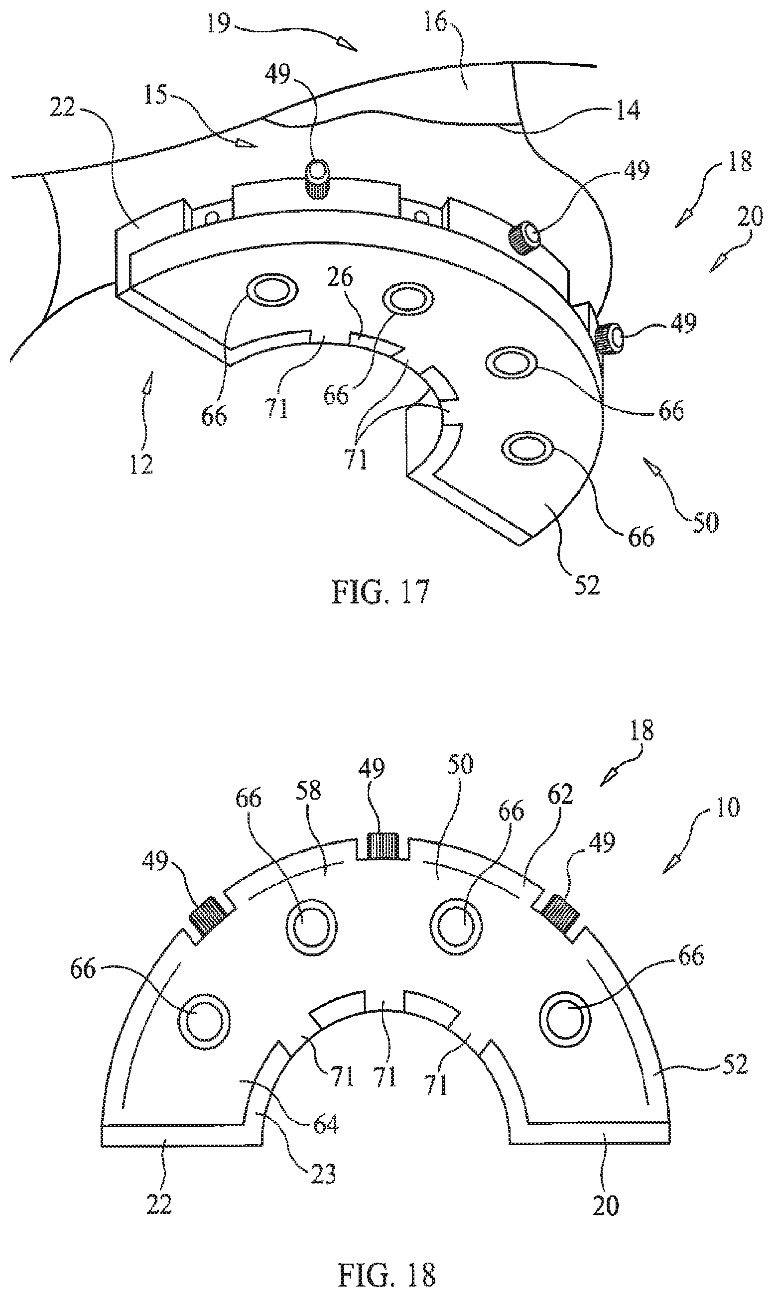 Patent US11779434 Figure 10 – Bone foundation guide system and method