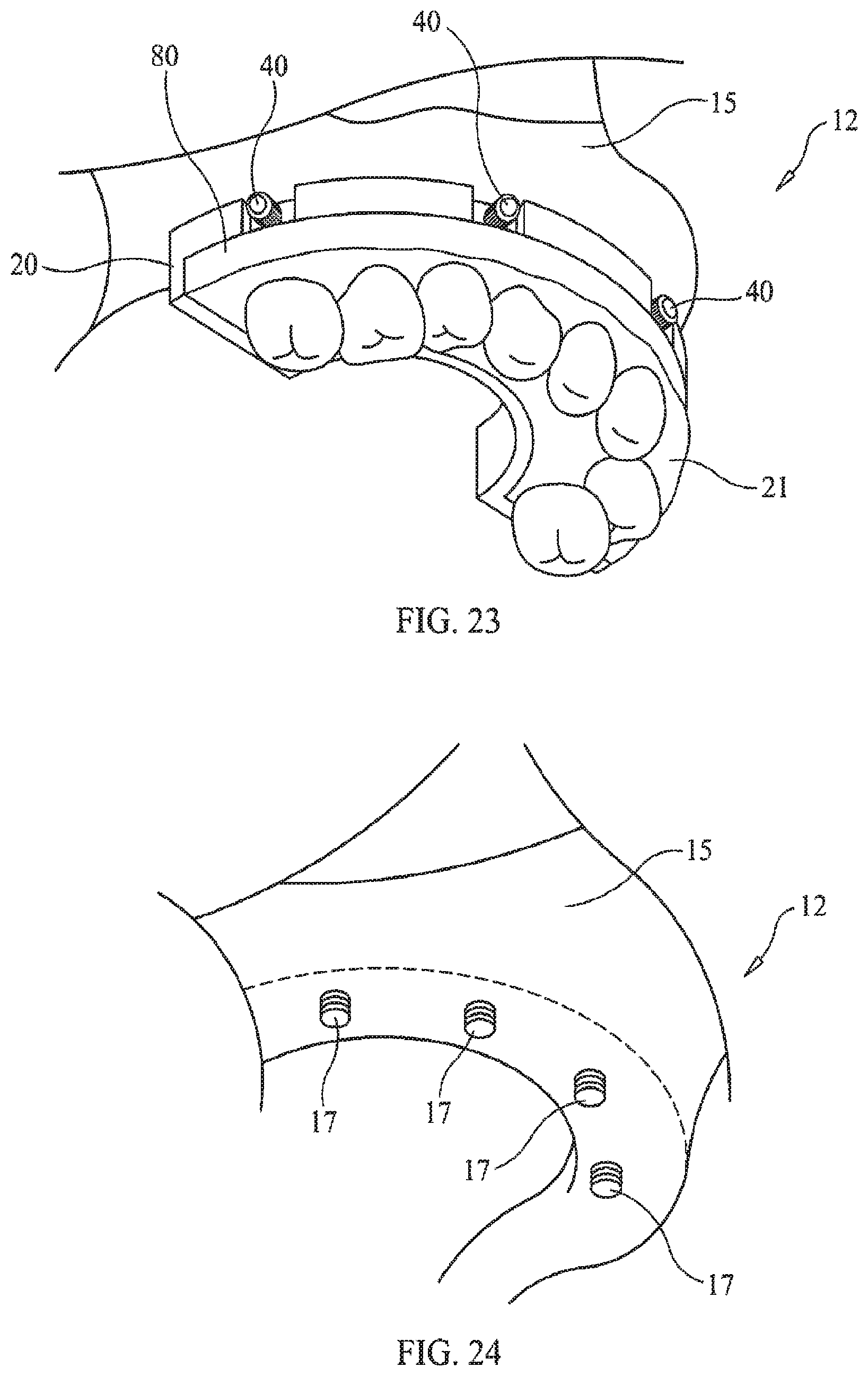 Patent US11779434 Figure 13 – Bone foundation guide system and method
