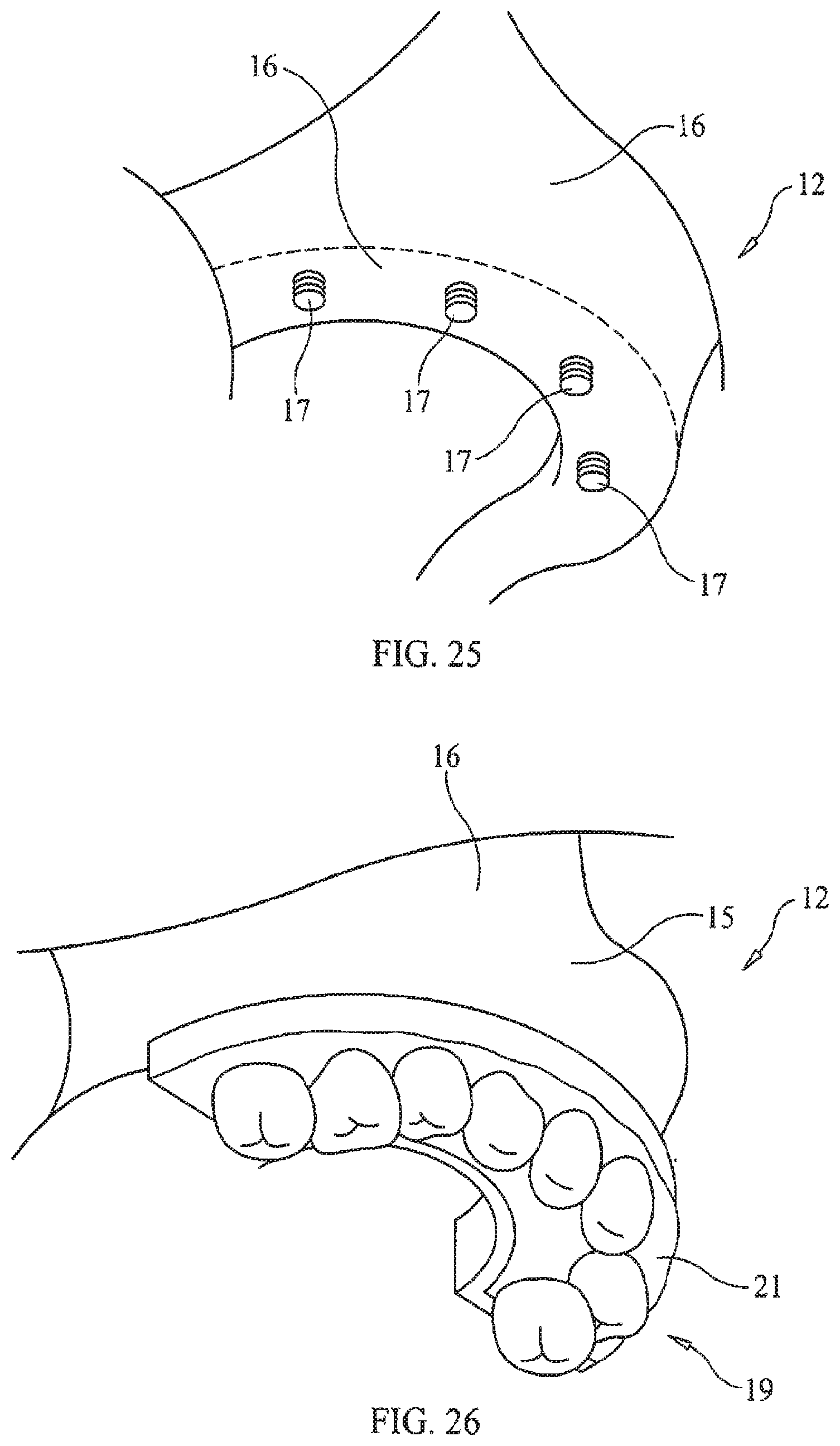 Patent US11779434 Figure 14 – Bone foundation guide system and method