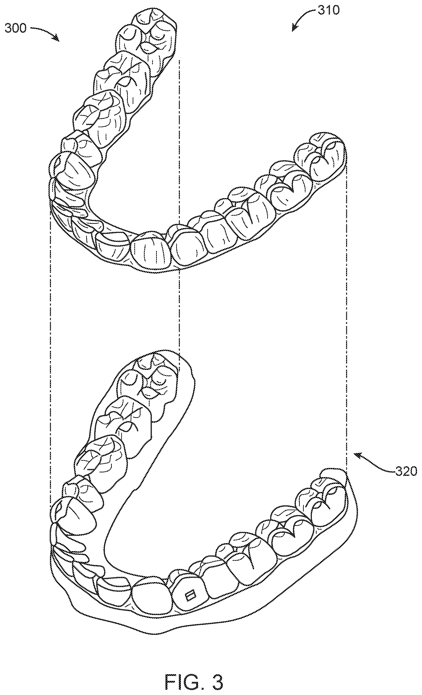 Patent US11779437 Figure 3 – Treatment of temperomandibular joint dysfunction with aligner therapy