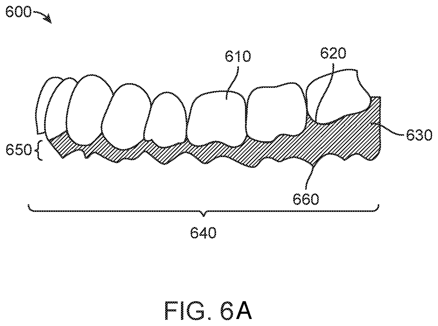 Patent US11779437 Figure 6 – Treatment of temperomandibular joint dysfunction with aligner therapy