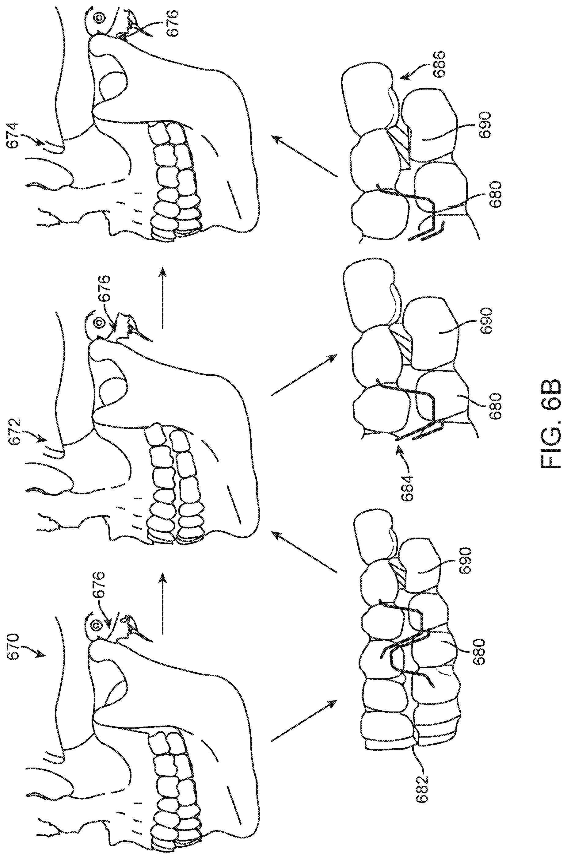 Patent US11779437 Figure 7 – Treatment of temperomandibular joint dysfunction with aligner therapy