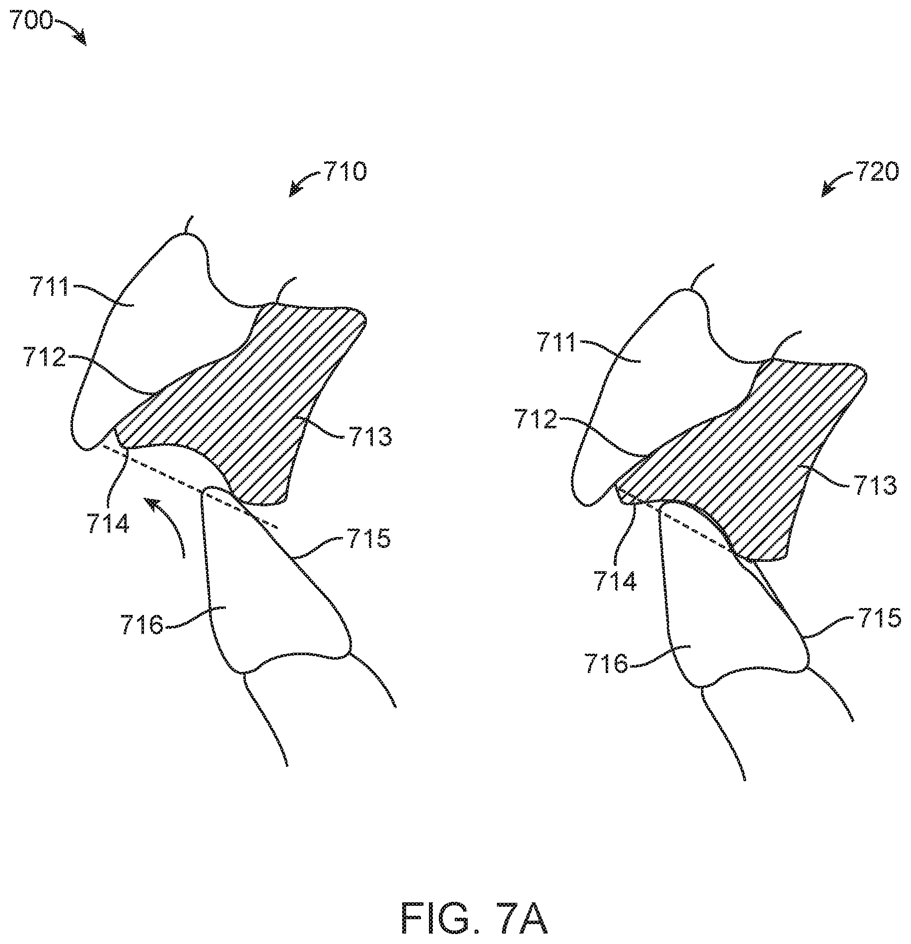 Patent US11779437 Figure 8 – Treatment of temperomandibular joint dysfunction with aligner therapy
