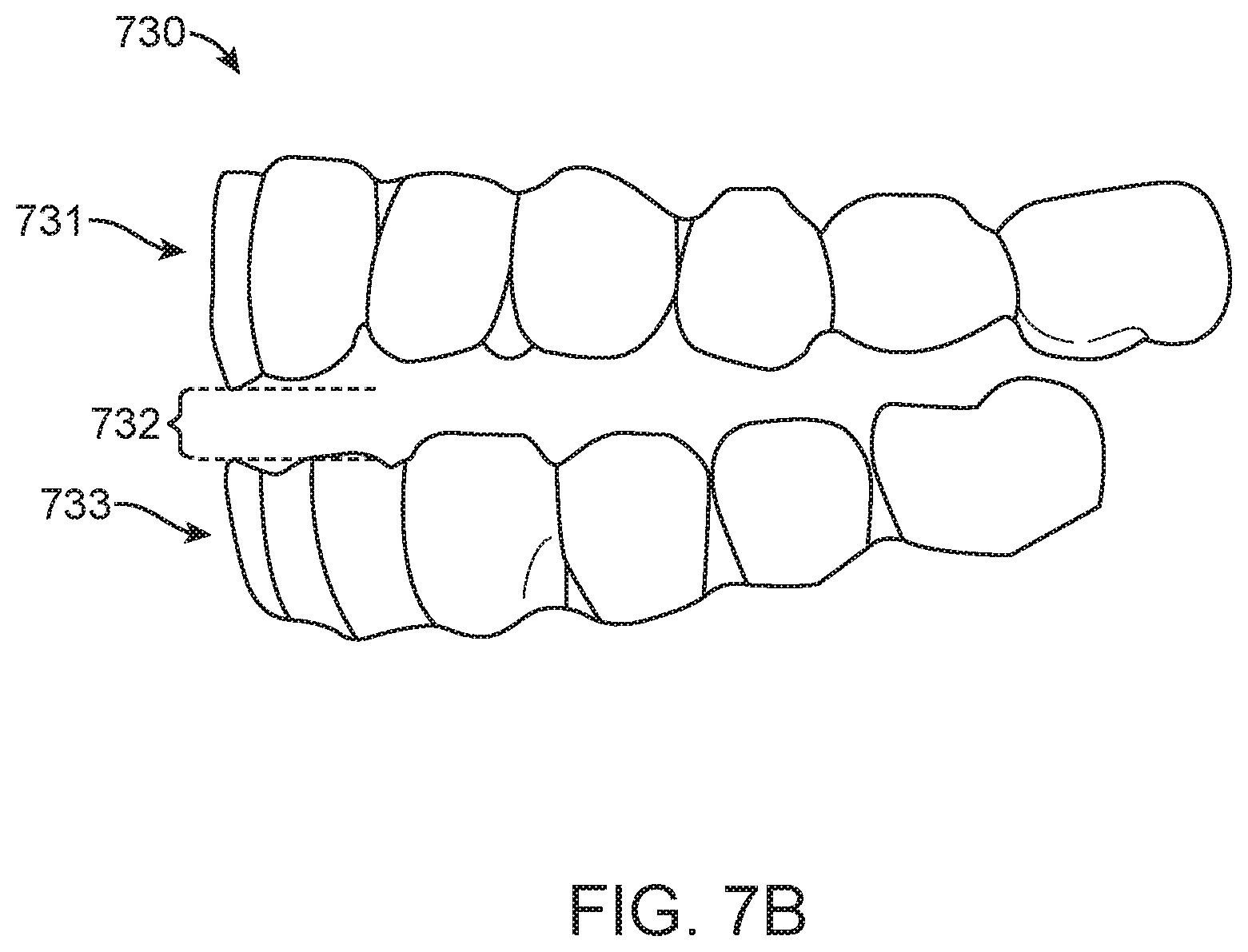 Patent US11779437 Figure 9 – Treatment of temperomandibular joint dysfunction with aligner therapy