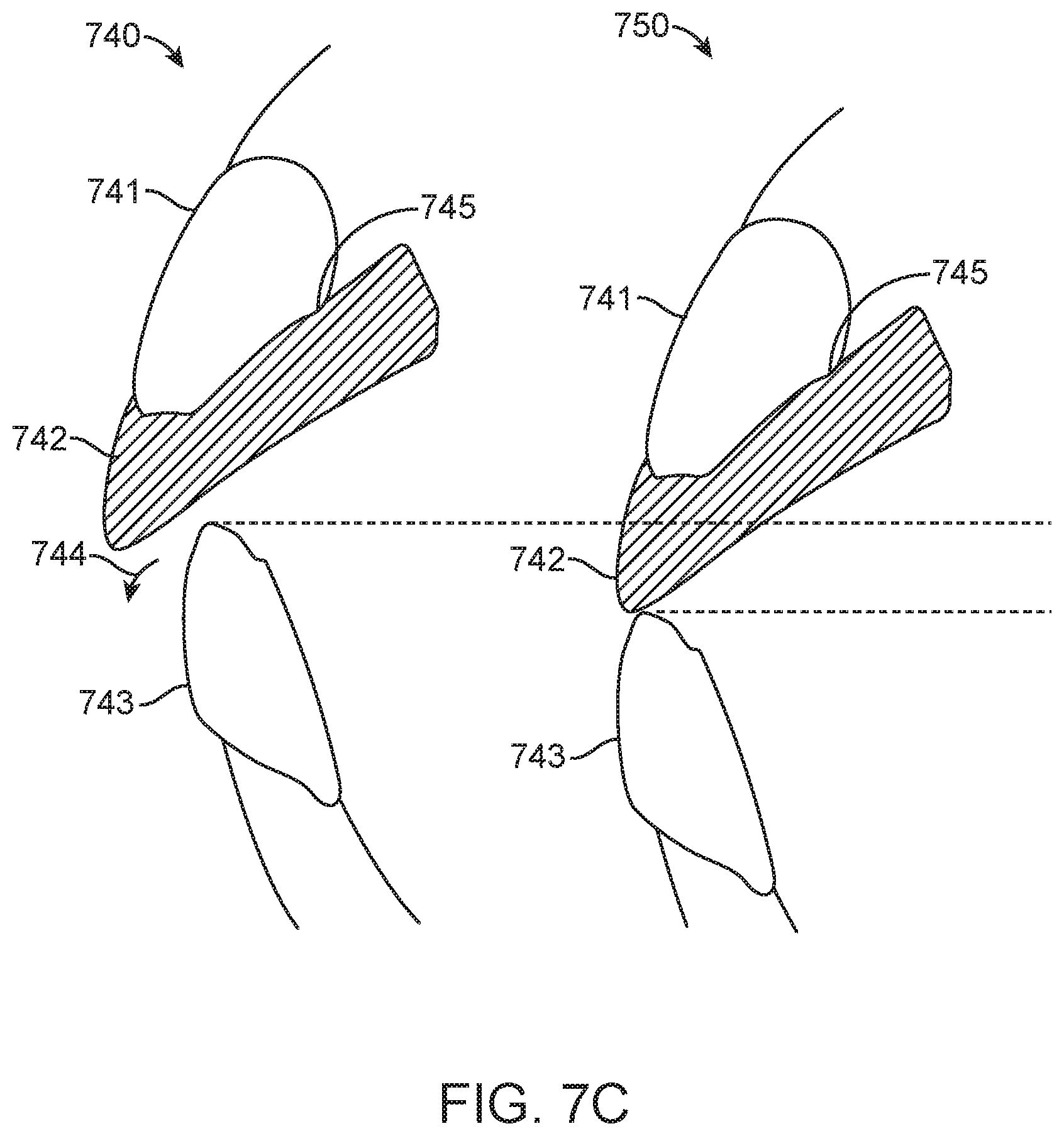 Patent US11779437 Figure 10 – Treatment of temperomandibular joint dysfunction with aligner therapy