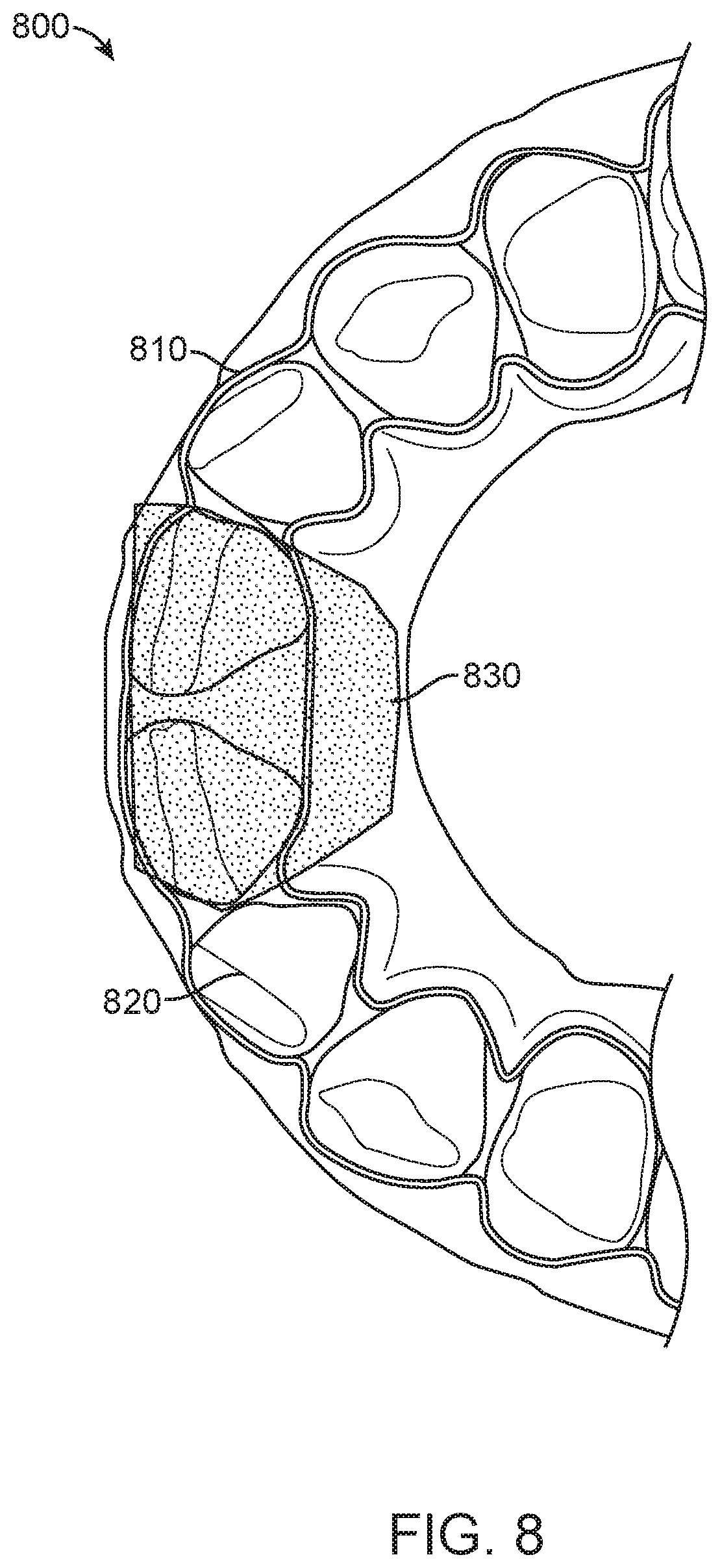Patent US11779437 Figure 11 – Treatment of temperomandibular joint dysfunction with aligner therapy