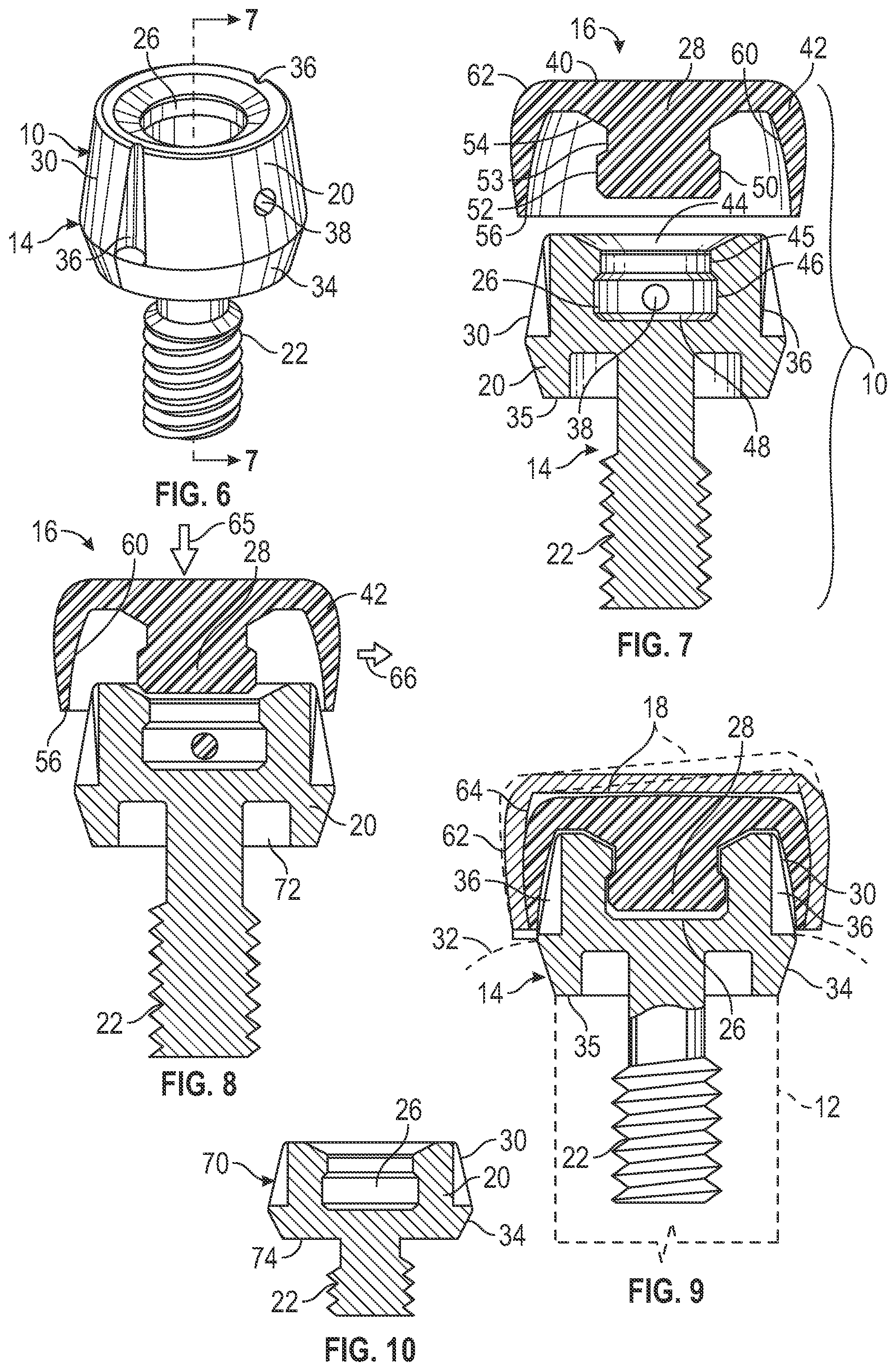 Patent US11779438 Figure 6 – Fixed hybrid dental attachment assembly and methods of use