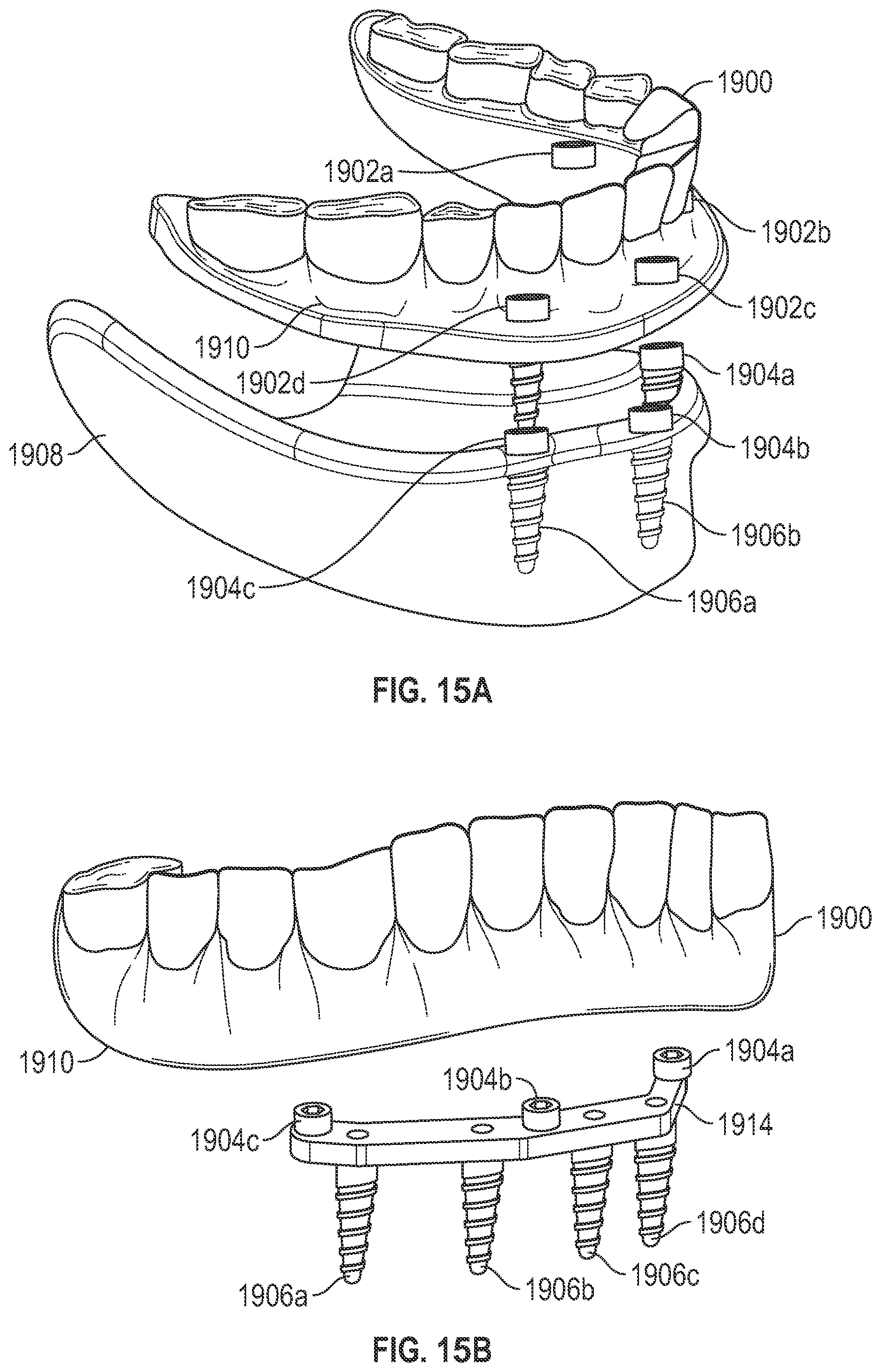 Patent US11779438 Figure 16 – Fixed hybrid dental attachment assembly and methods of use
