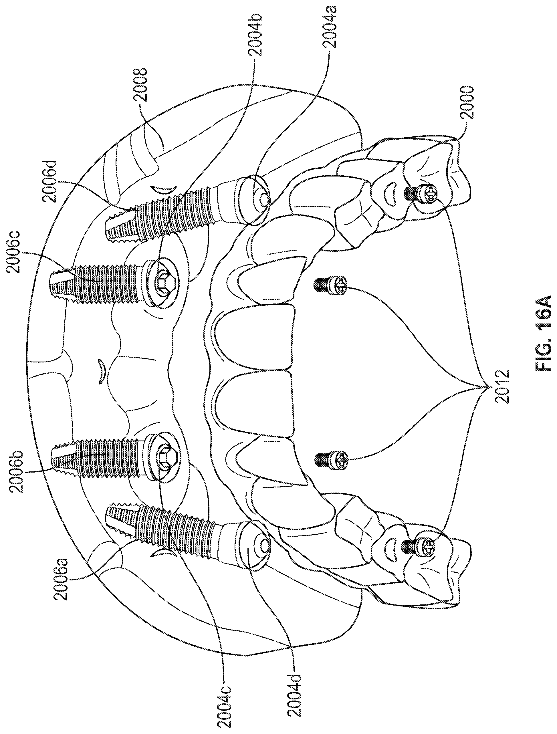 Patent US11779438 Figure 17 – Fixed hybrid dental attachment assembly and methods of use