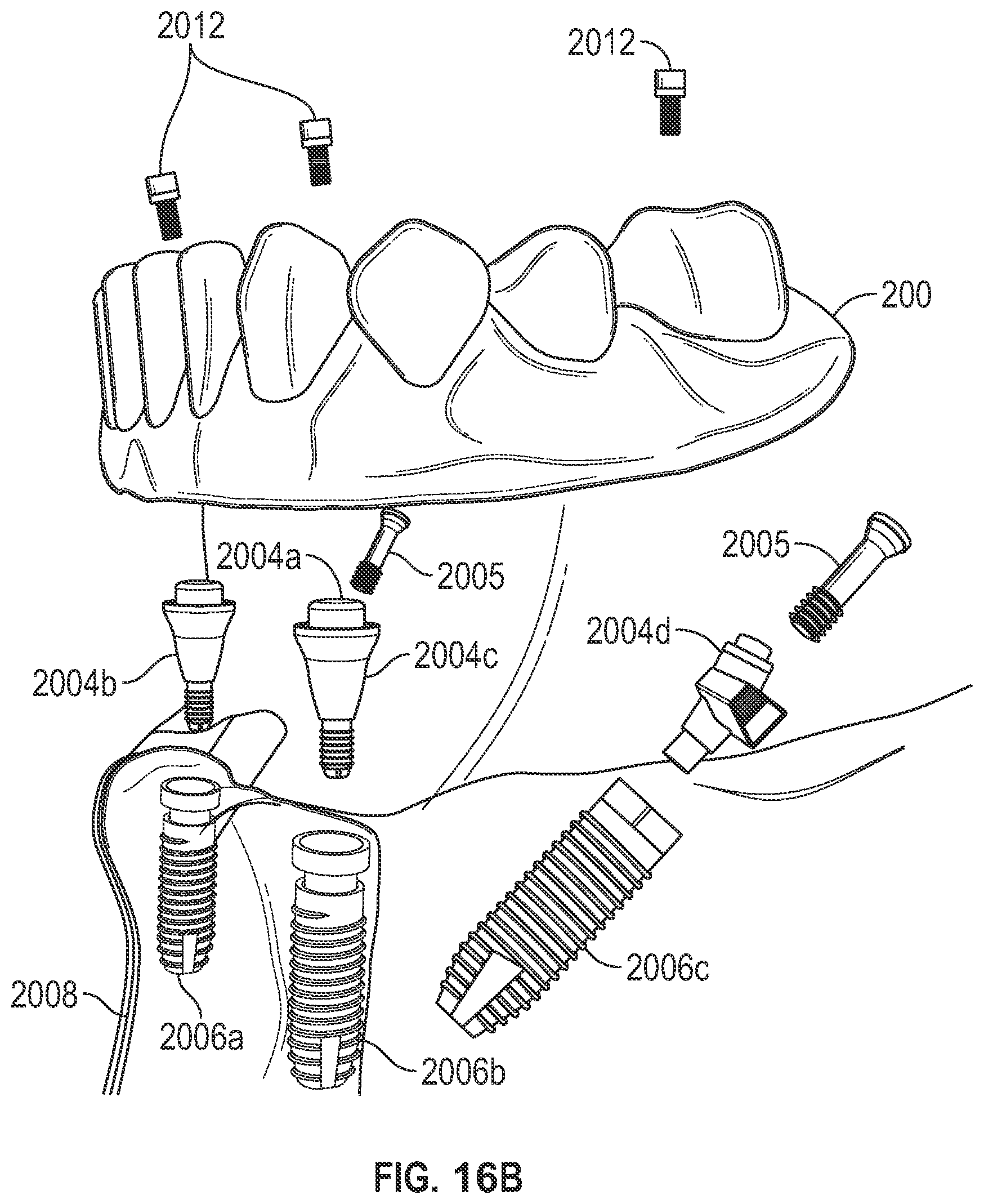 Patent US11779438 Figure 18 – Fixed hybrid dental attachment assembly and methods of use
