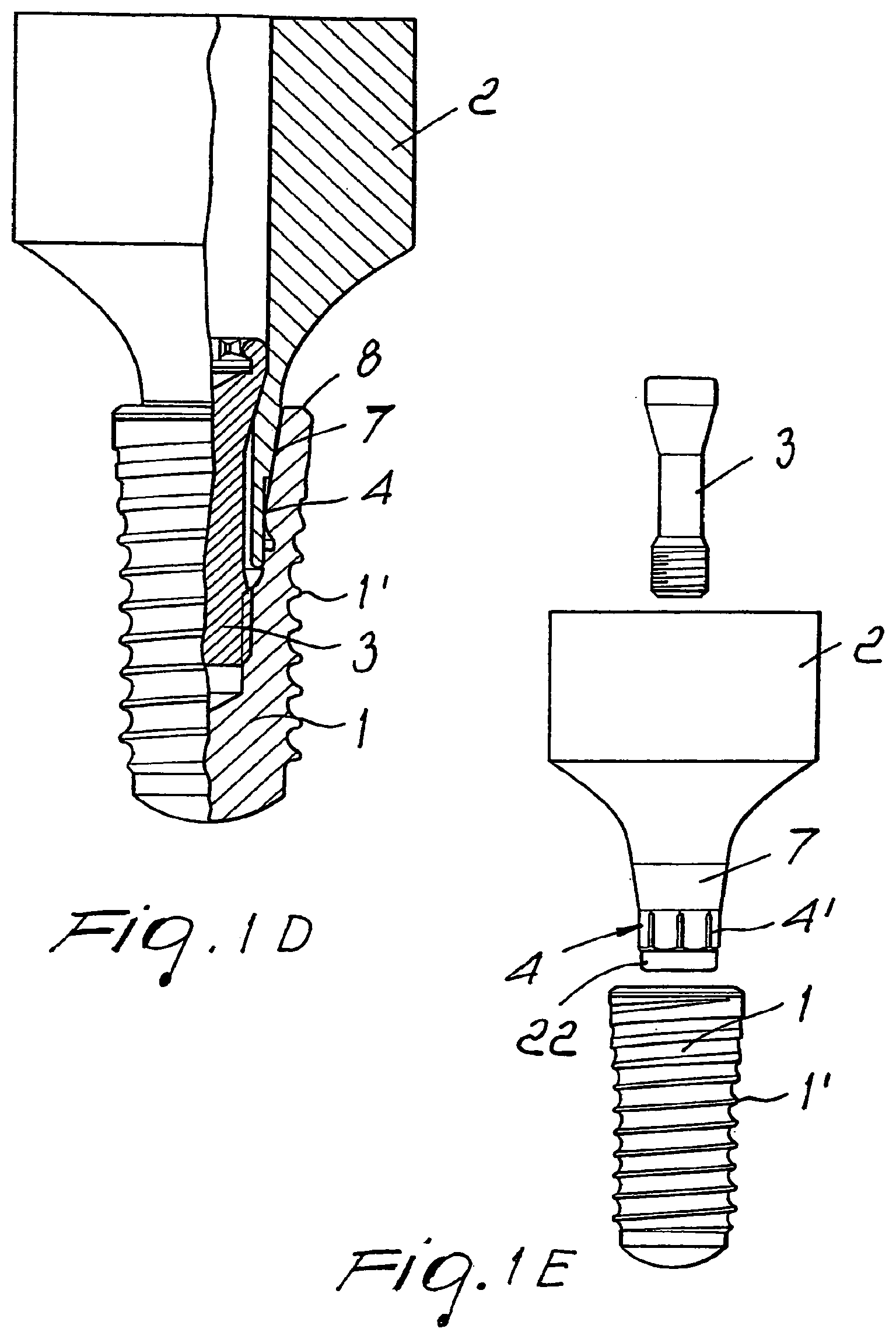 Patent US11779439 Figure 2 – Coupling for a multi-part dental implant system
