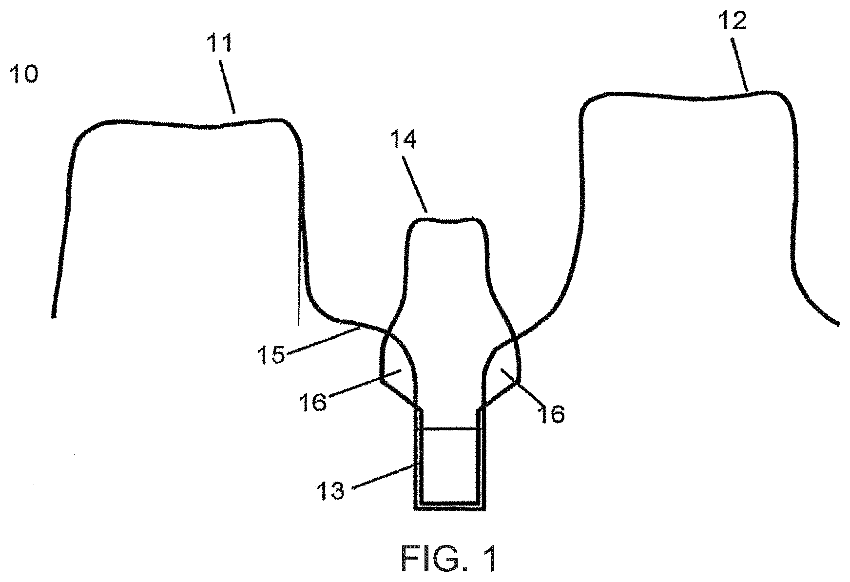 Patent US11779440 Figure 1 – Method of modifying the gingival part of a virtual model of a set of teeth