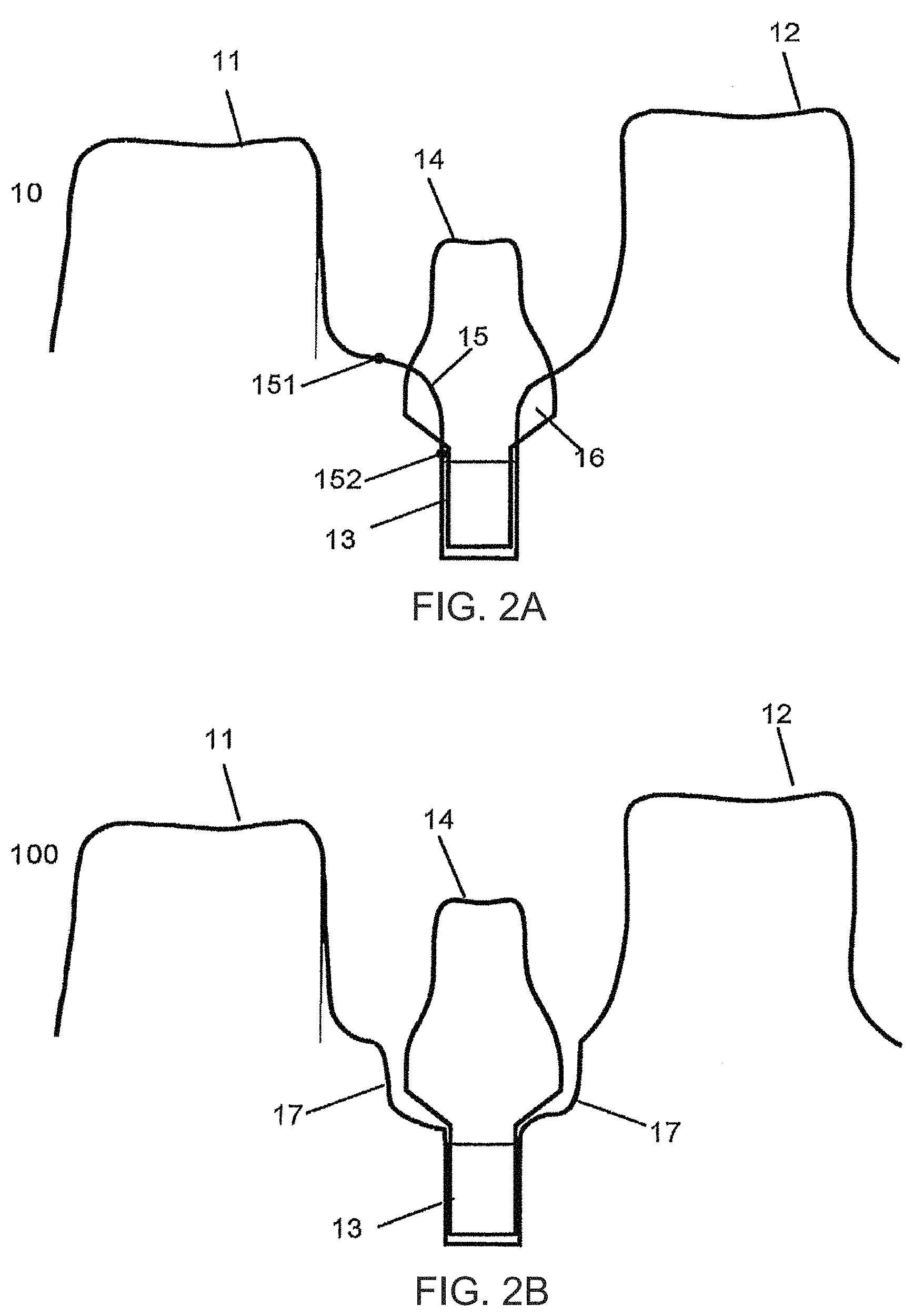 Patent US11779440 Figure 2 – Method of modifying the gingival part of a virtual model of a set of teeth