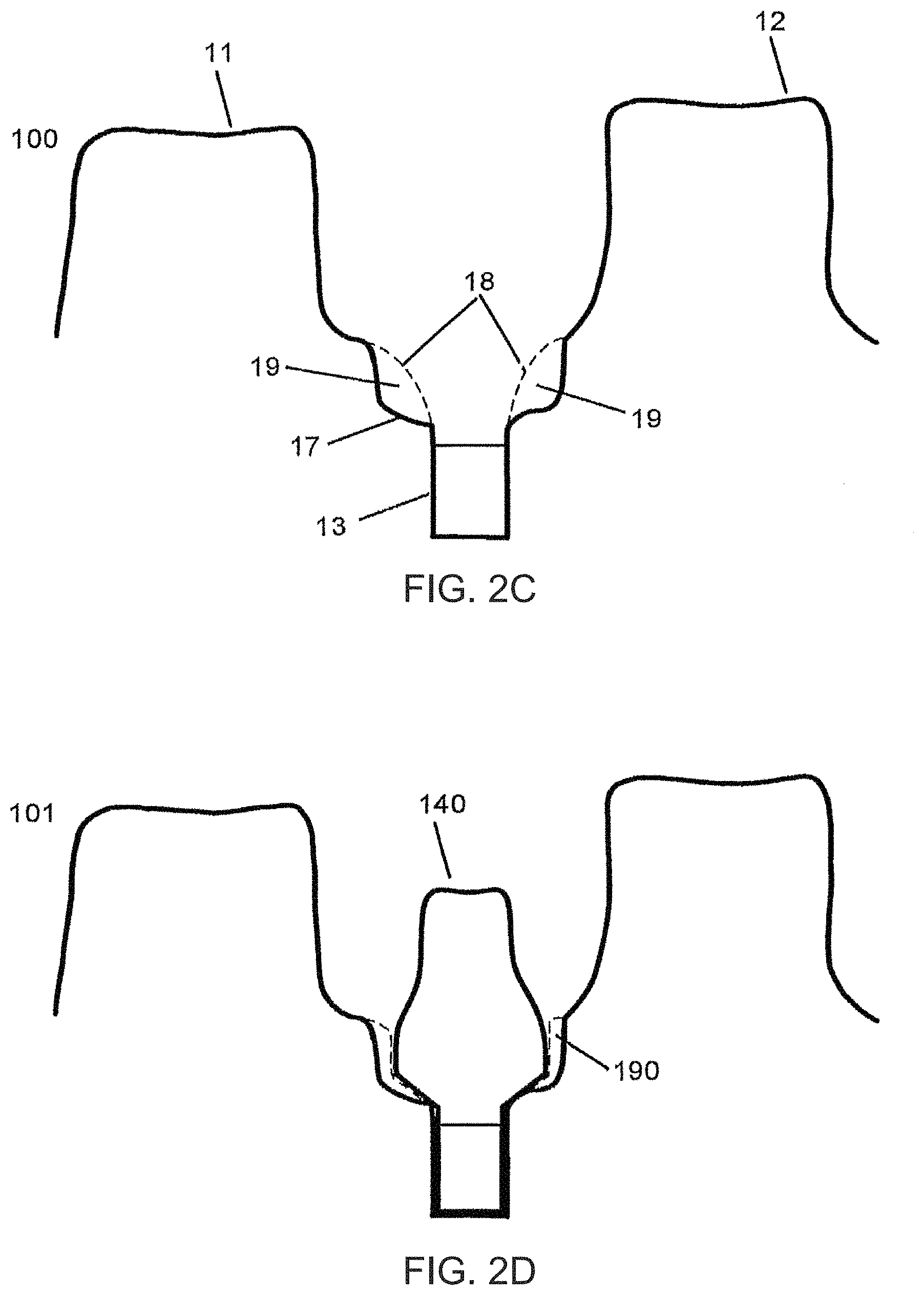 Patent US11779440 Figure 3 – Method of modifying the gingival part of a virtual model of a set of teeth