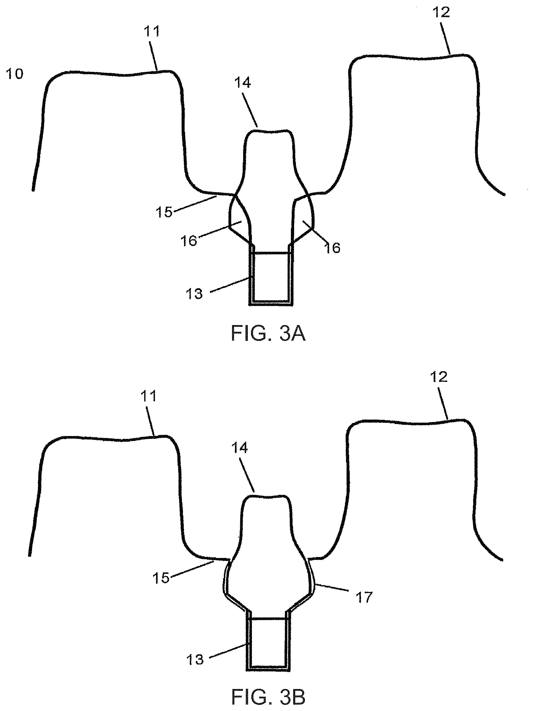 Patent US11779440 Figure 4 – Method of modifying the gingival part of a virtual model of a set of teeth