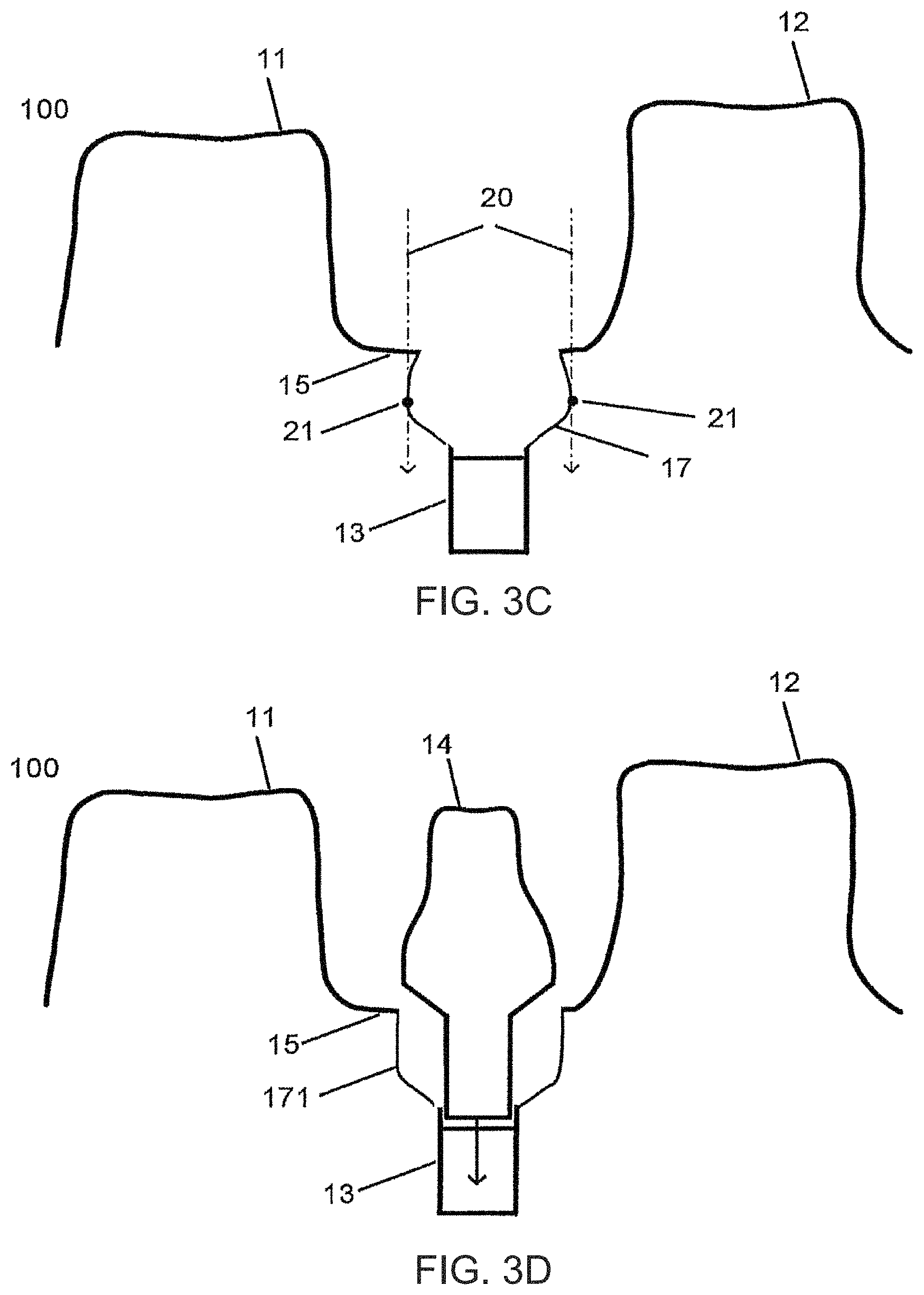 Patent US11779440 Figure 5 – Method of modifying the gingival part of a virtual model of a set of teeth