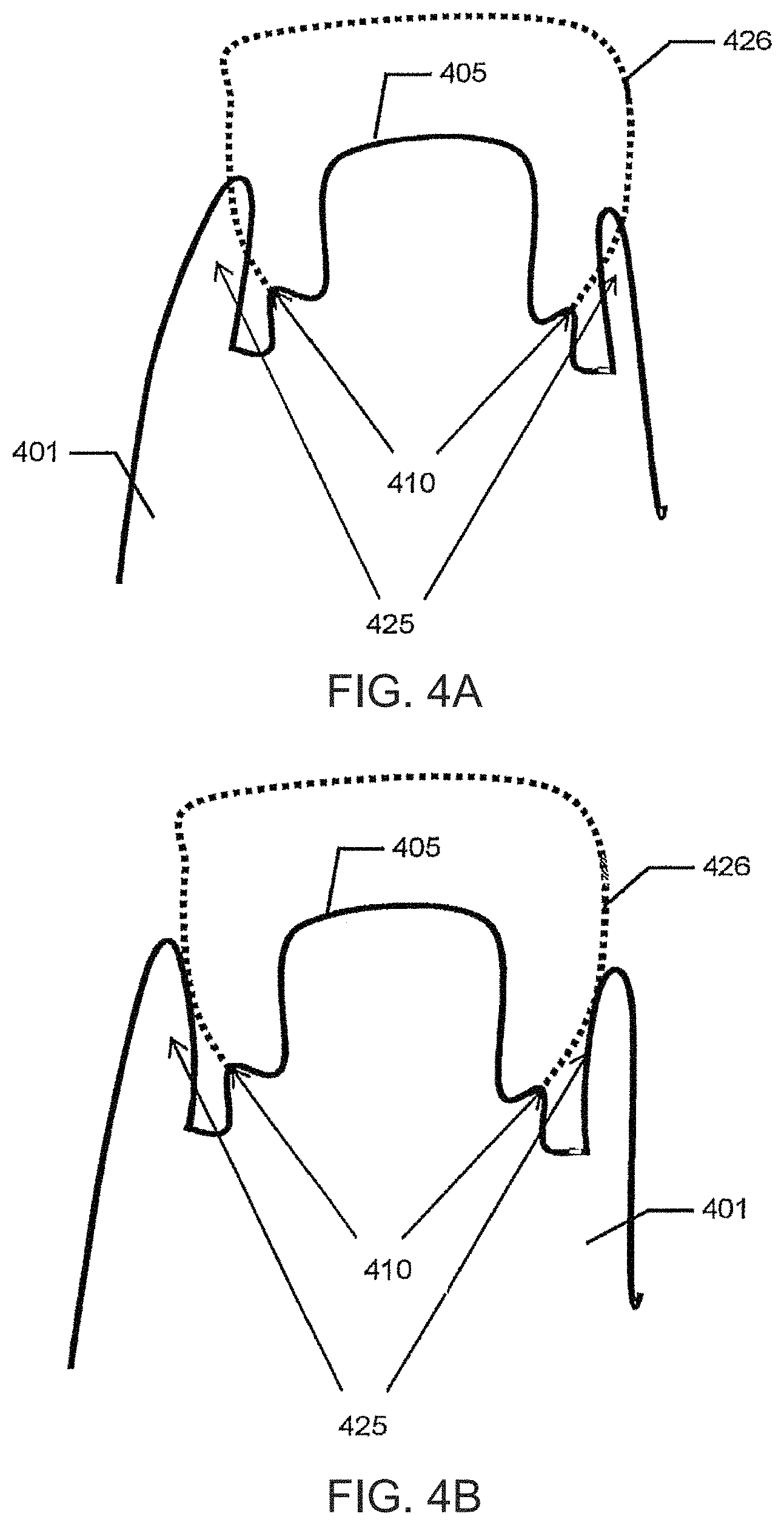 Patent US11779440 Figure 6 – Method of modifying the gingival part of a virtual model of a set of teeth