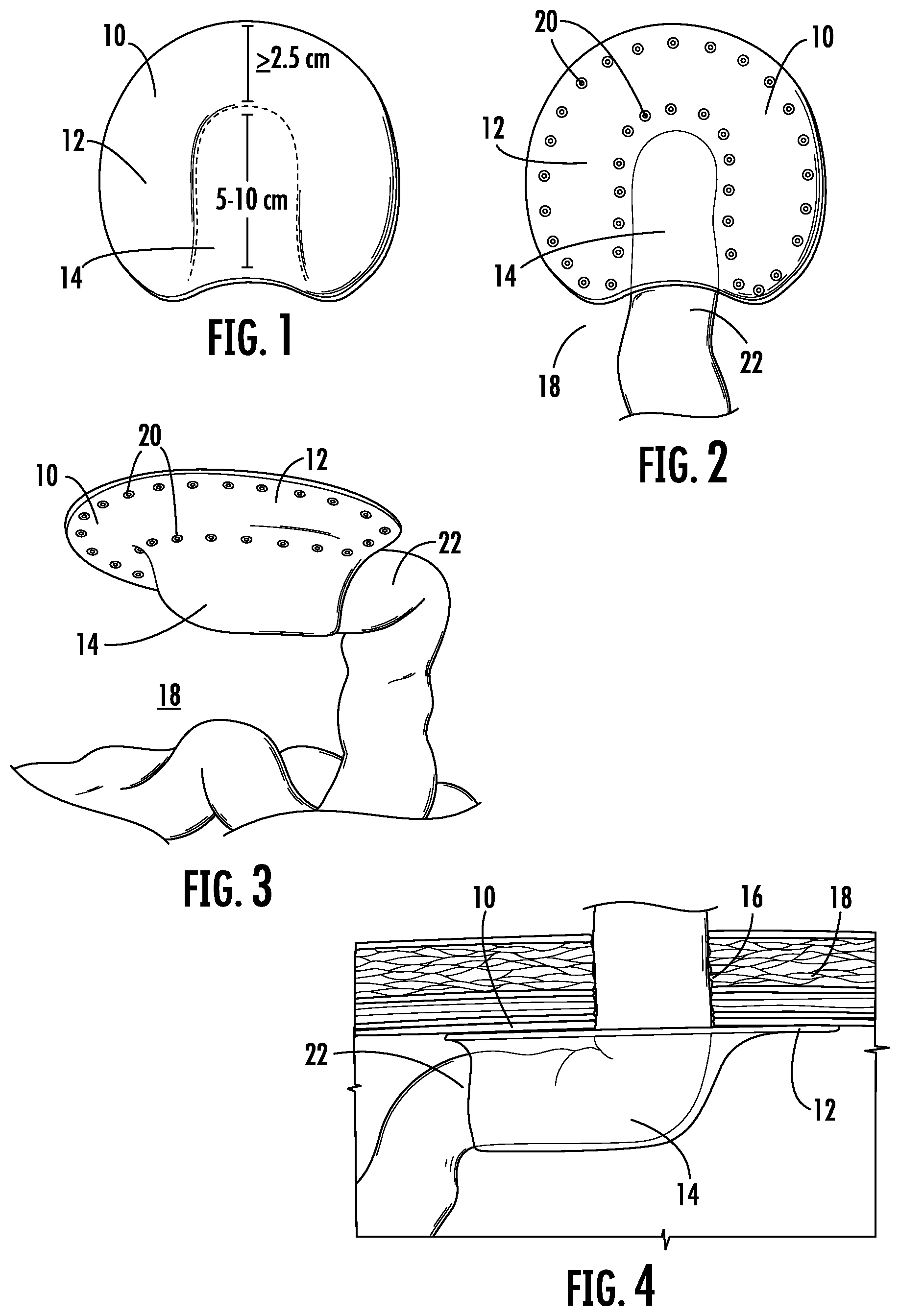 Patent US11779448 Figure 1 – Pre-formed parastomal hernia reinforcement mesh