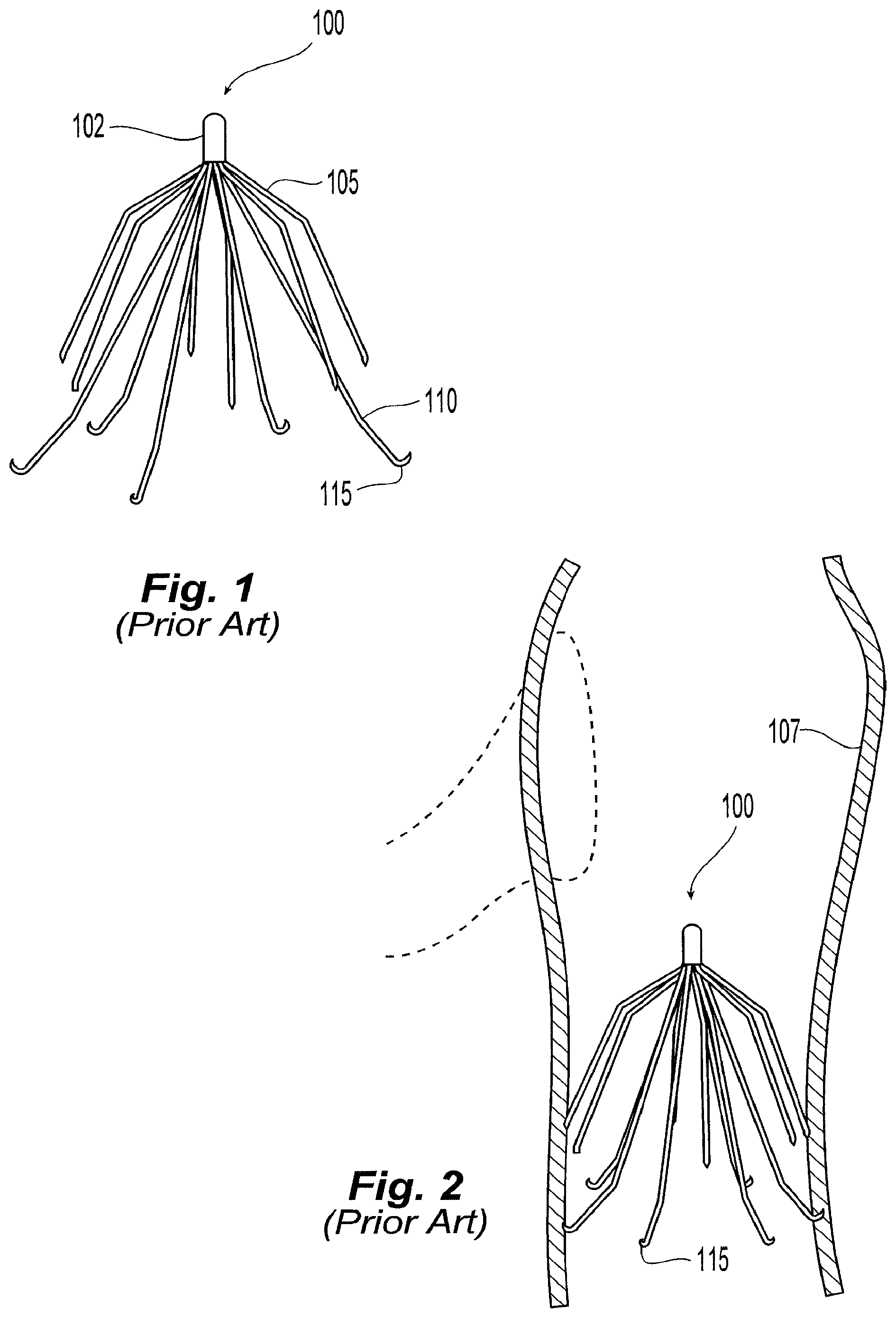 Patent US11779449 Figure 1 – Inferior vena cava filter with stability features