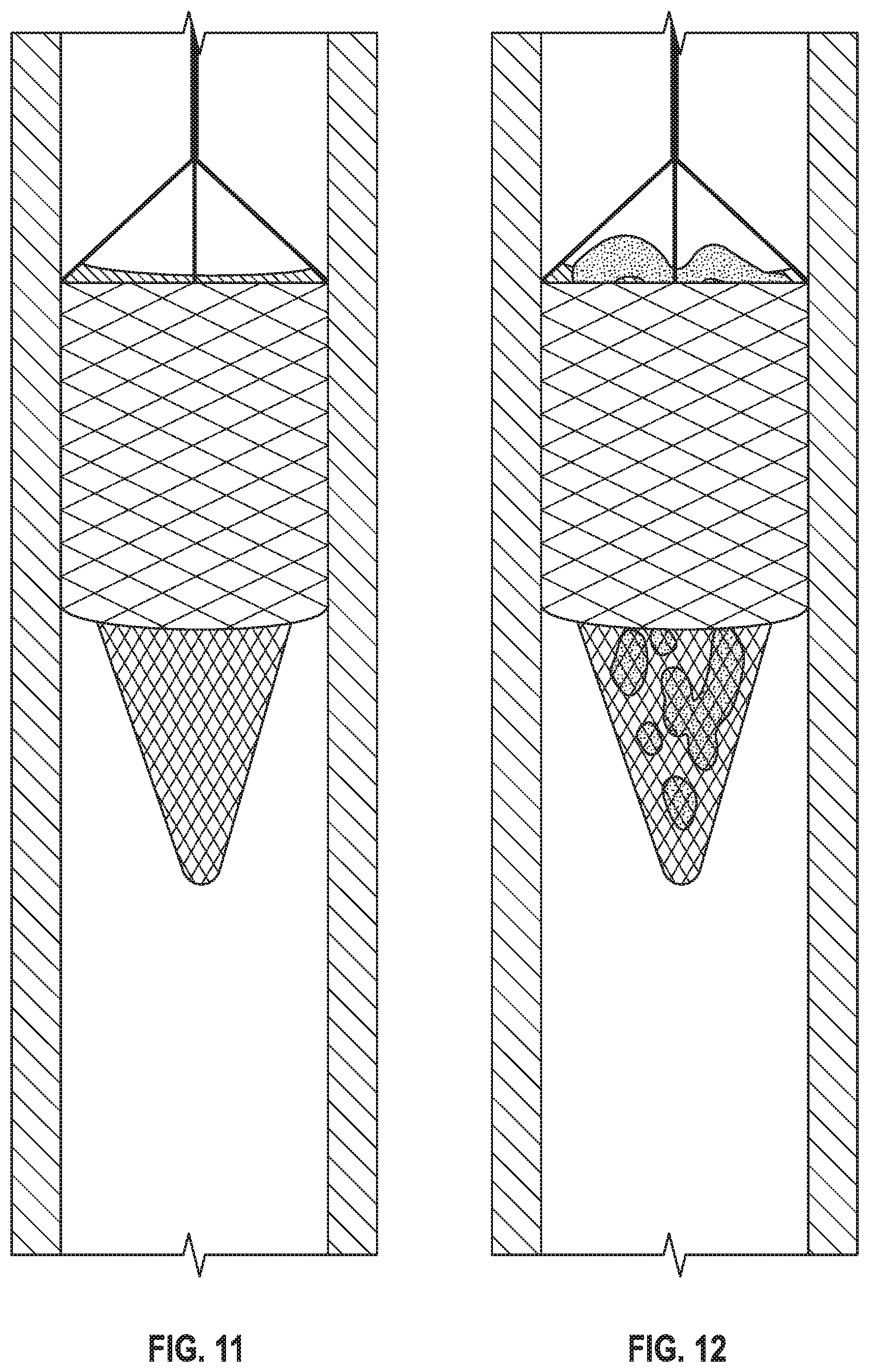 Patent US11779451 Figure 11 – Peripheral vascular filtration systems and methods
