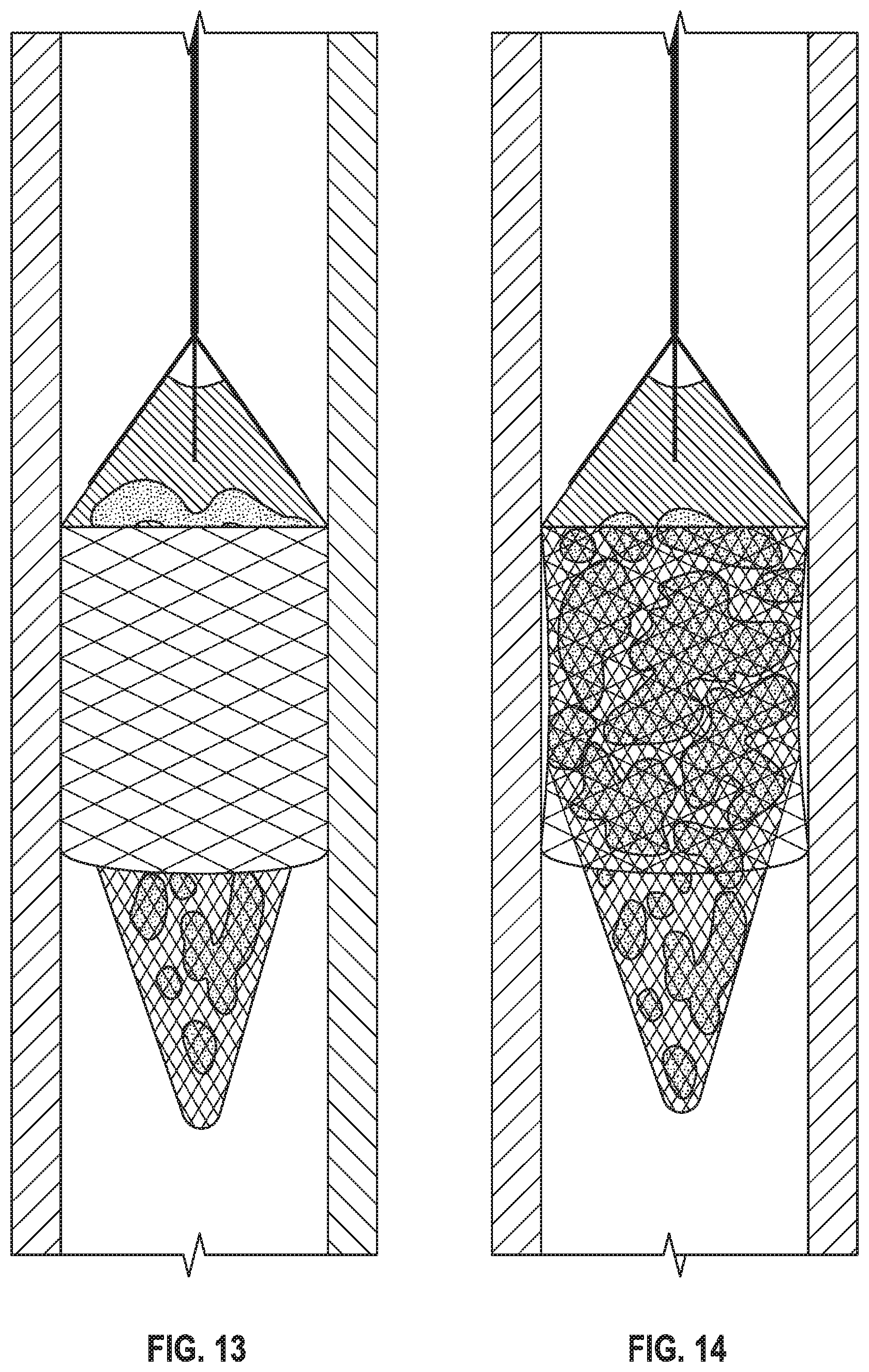 Patent US11779451 Figure 12 – Peripheral vascular filtration systems and methods