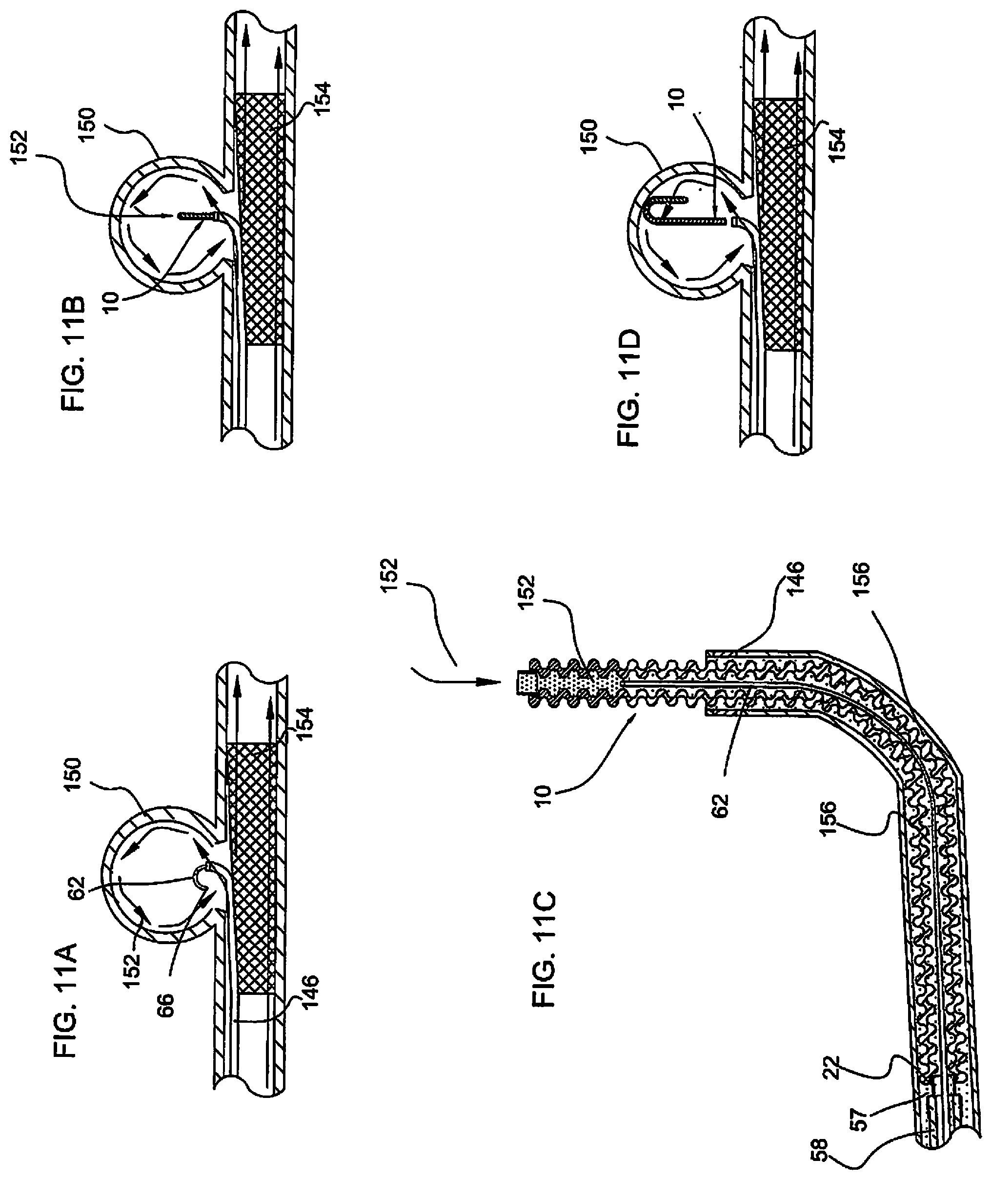 Patent US11779452 Figure 12 – Vascular implant