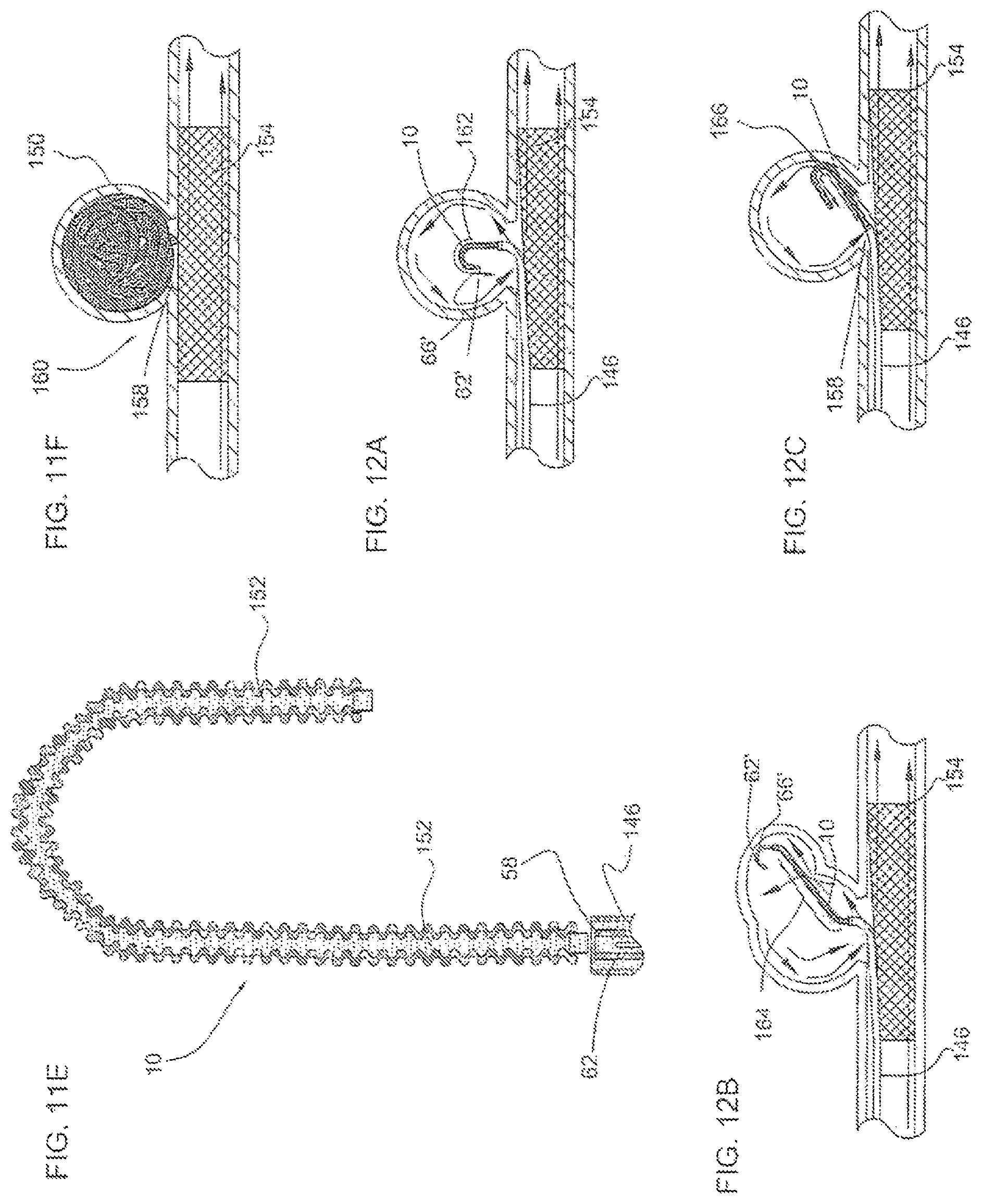 Patent US11779452 Figure 13 – Vascular implant