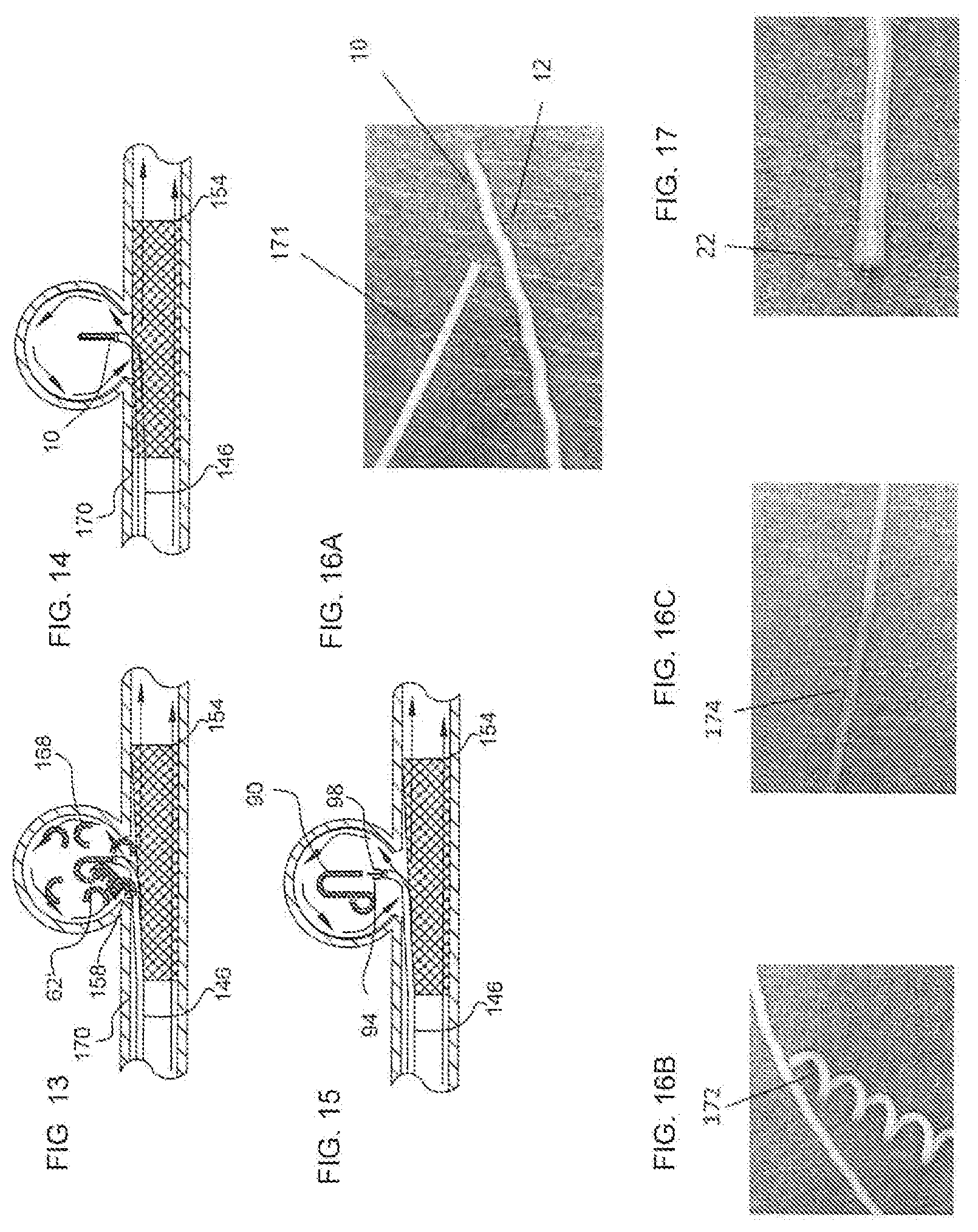 Patent US11779452 Figure 14 – Vascular implant