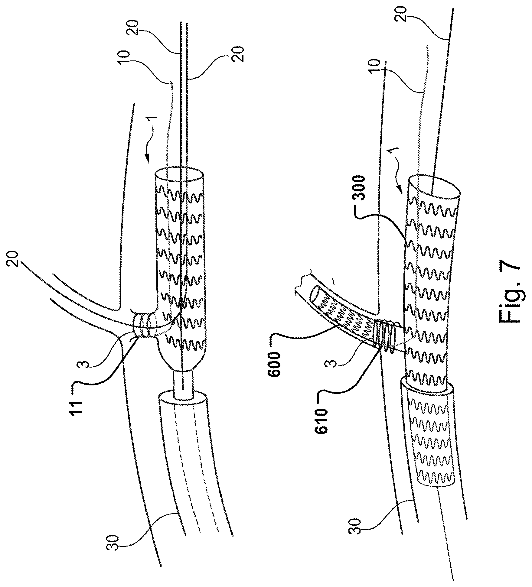 Patent US11779453 Figure 5 – Stent-graft prosthesis, system and method for improved delivery of a stent-graft prosthesis