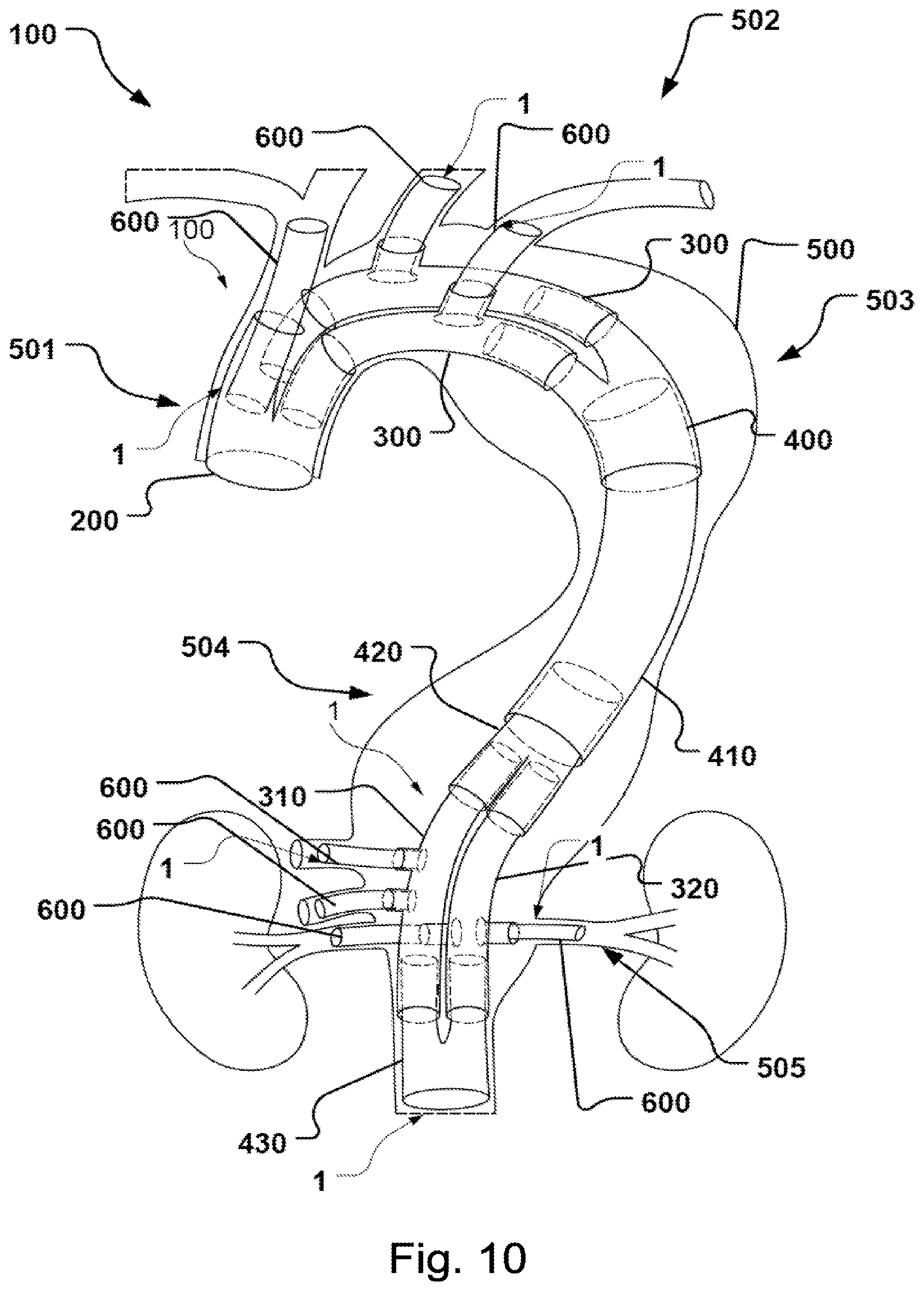 Patent US11779453 Figure 8 – Stent-graft prosthesis, system and method for improved delivery of a stent-graft prosthesis