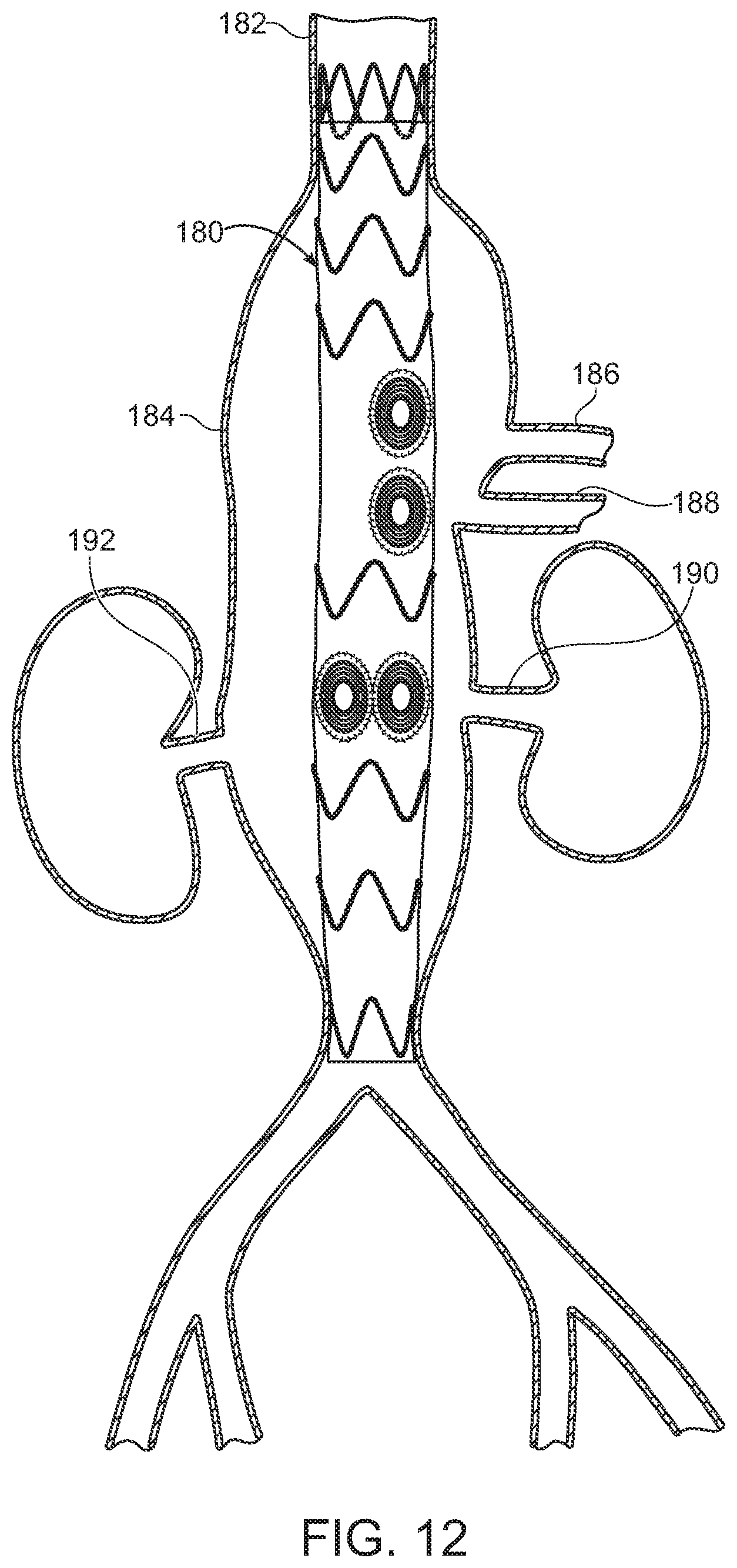 Patent US11779454 Figure 9 – Vascular prosthesis with crimped adapter and methods of use