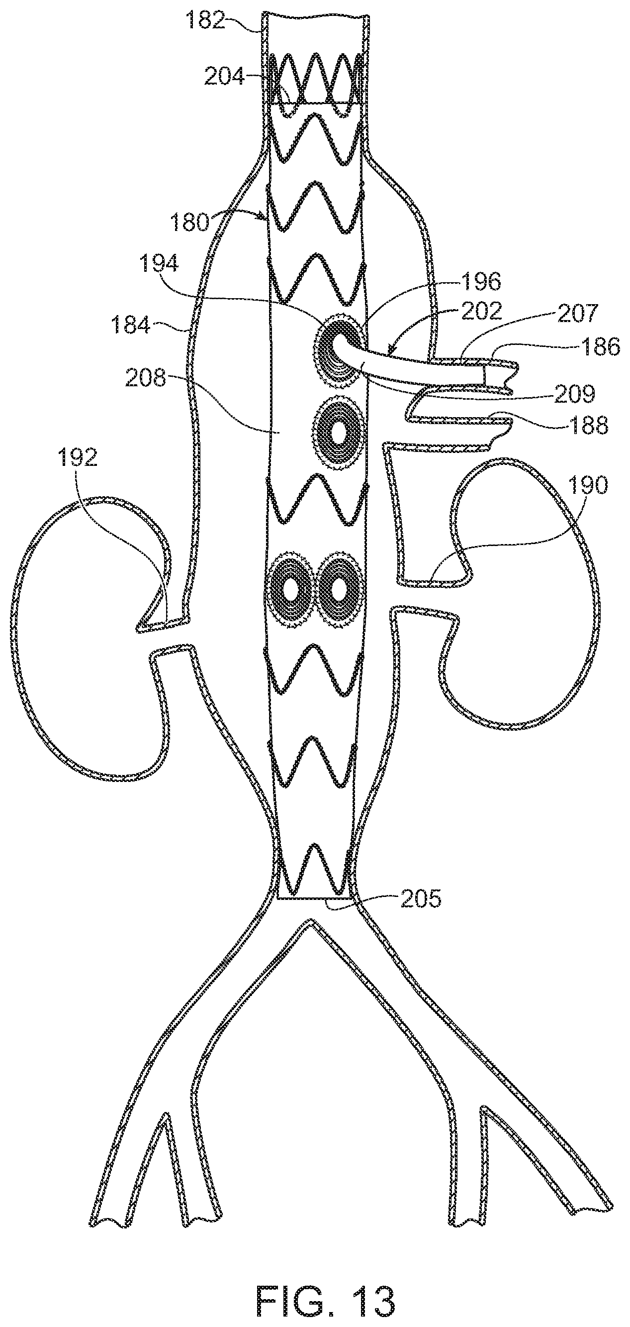 Patent US11779454 Figure 10 – Vascular prosthesis with crimped adapter and methods of use