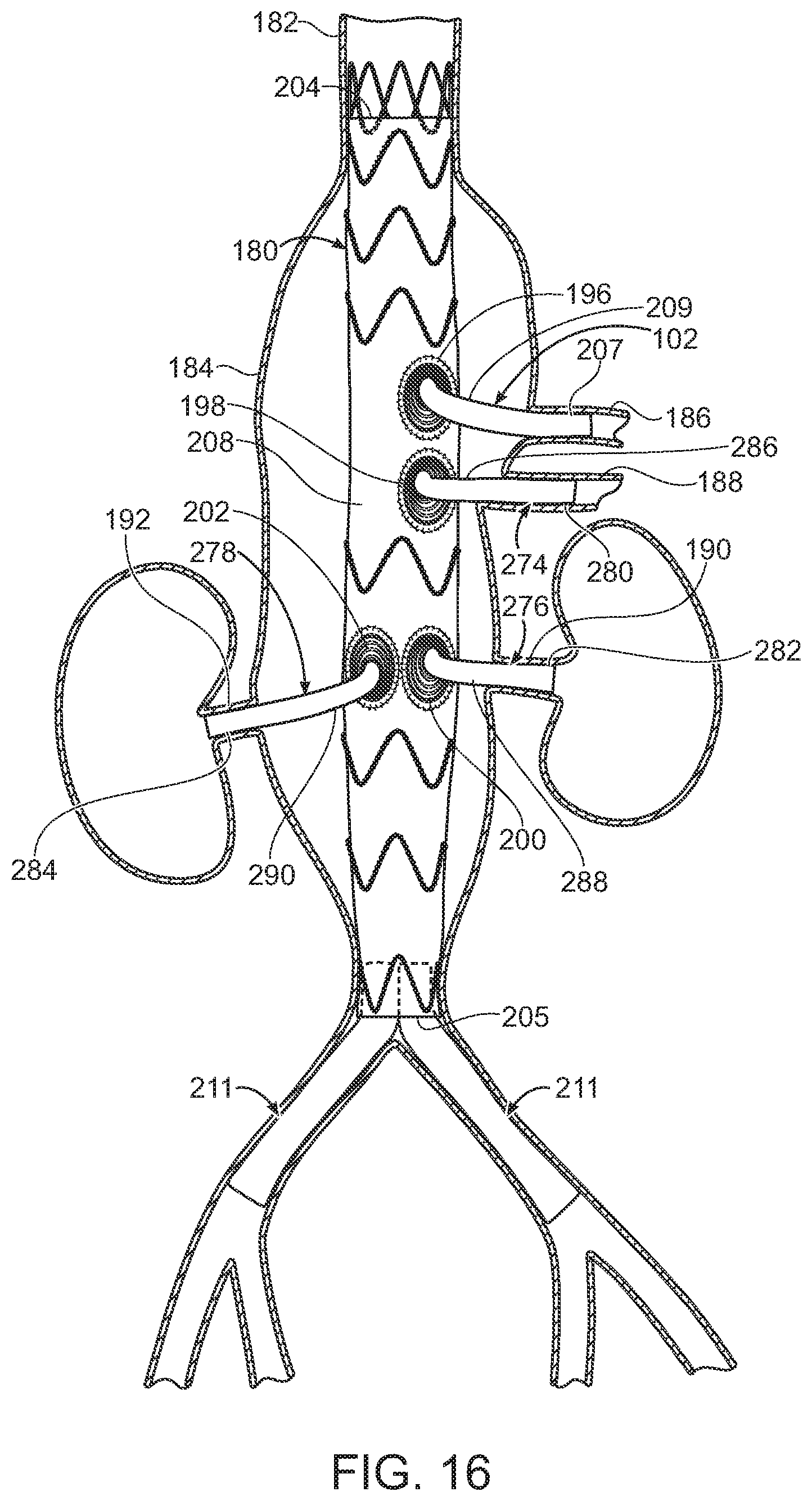 Patent US11779454 Figure 12 – Vascular prosthesis with crimped adapter and methods of use