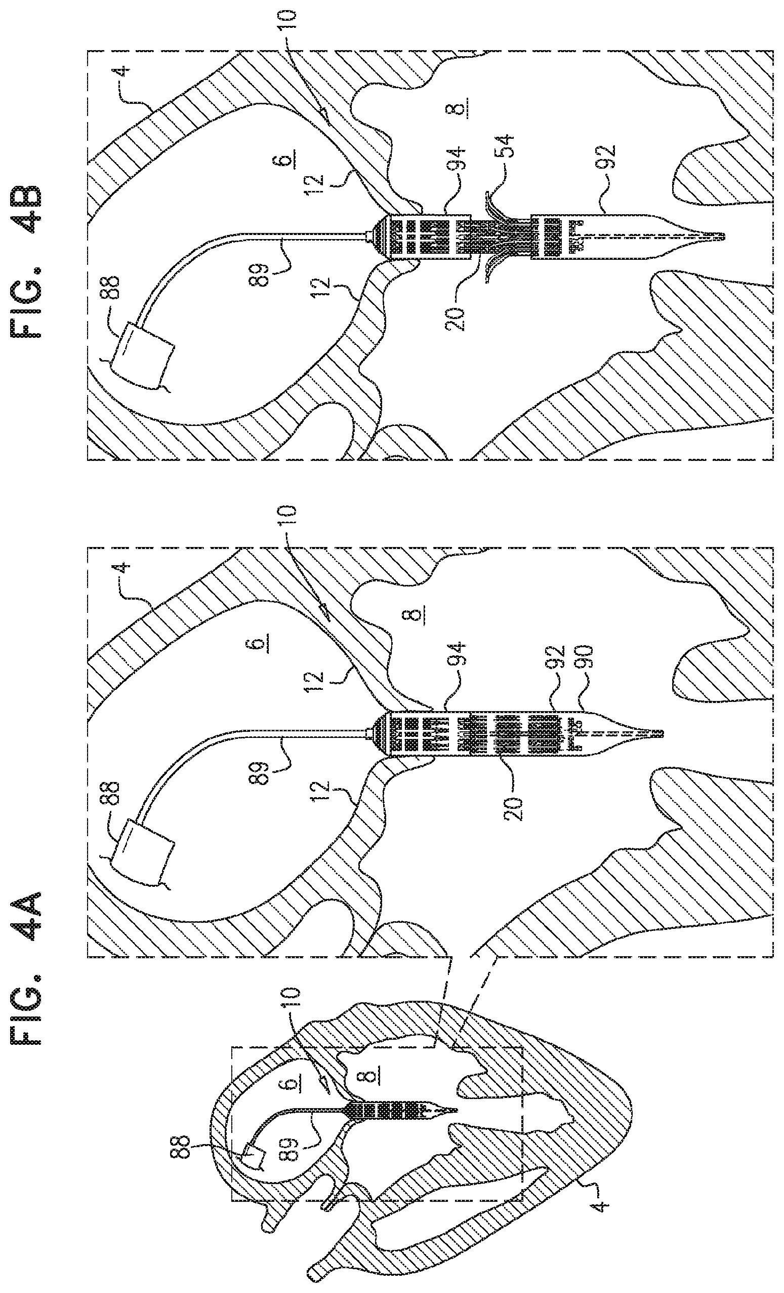 Patent US11779458 Figure 7 – Prosthetic valve with leaflet connectors