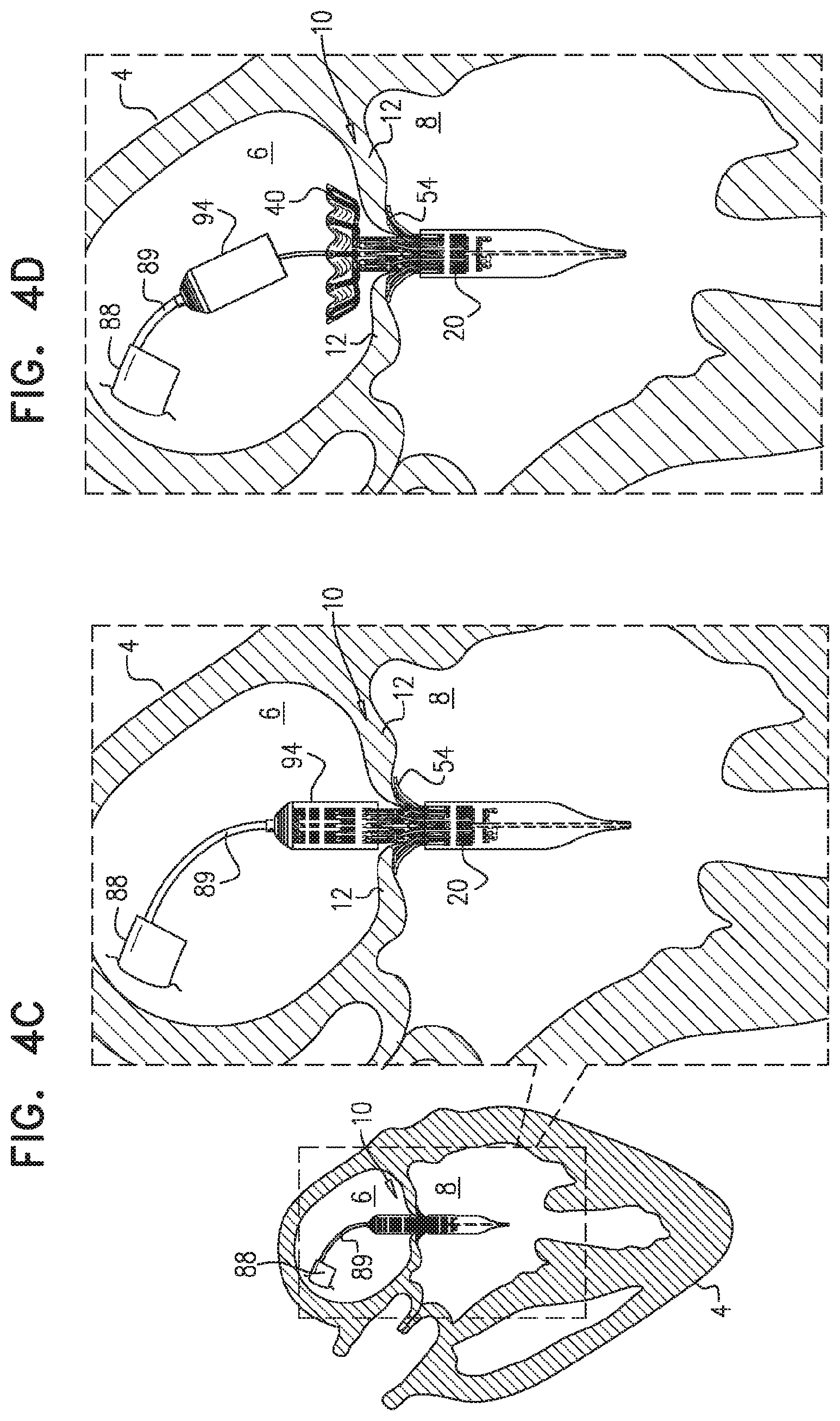 Patent US11779458 Figure 8 – Prosthetic valve with leaflet connectors