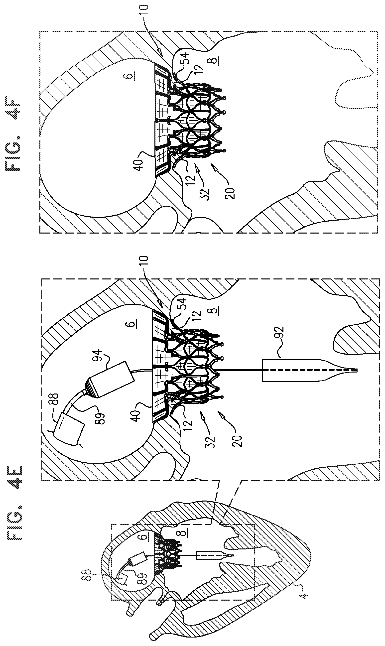 Patent US11779458 Figure 9 – Prosthetic valve with leaflet connectors