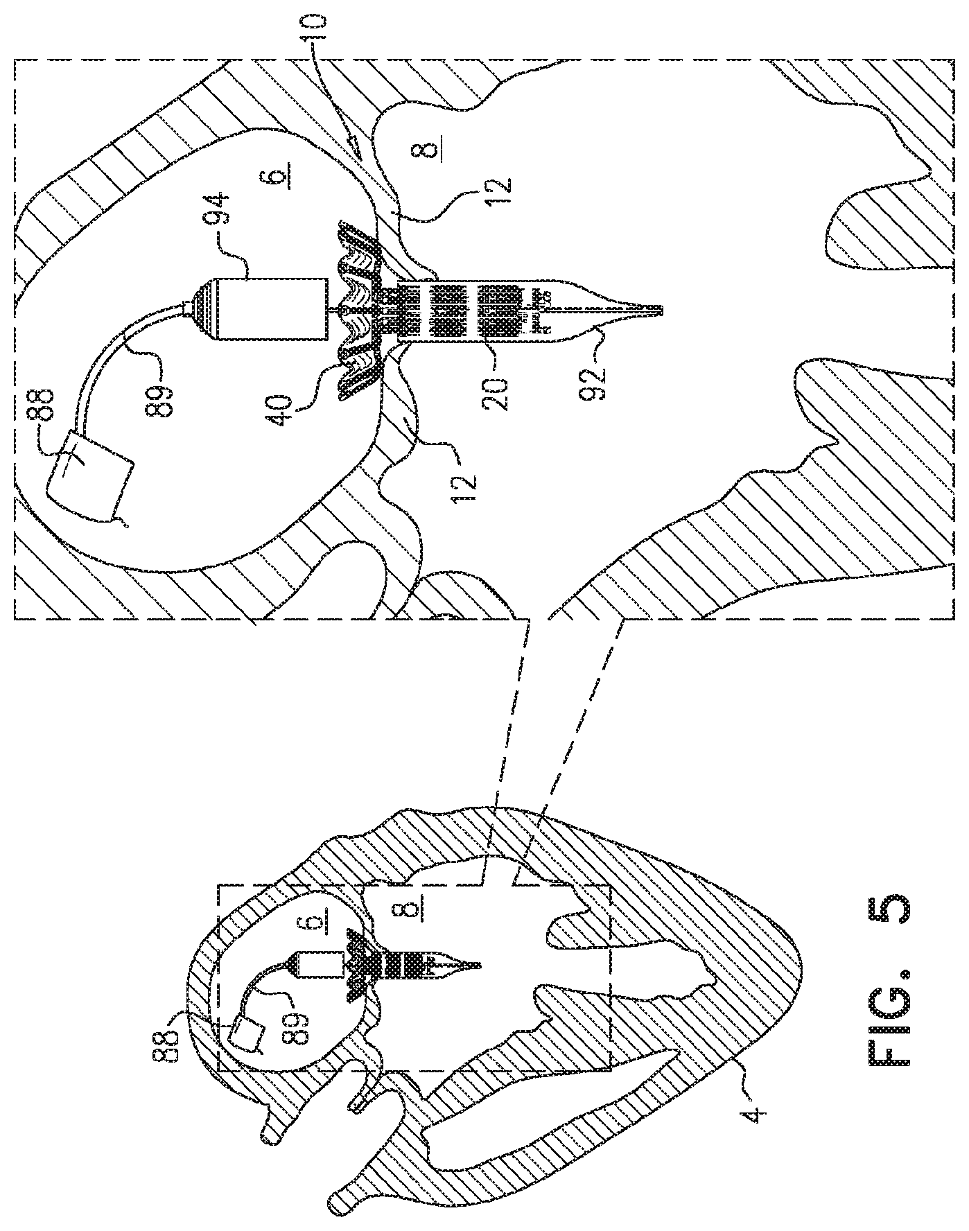Patent US11779458 Figure 10 – Prosthetic valve with leaflet connectors